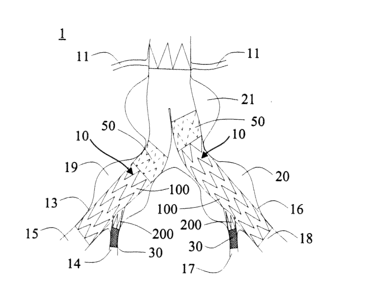 Fork-Type Covered Stent