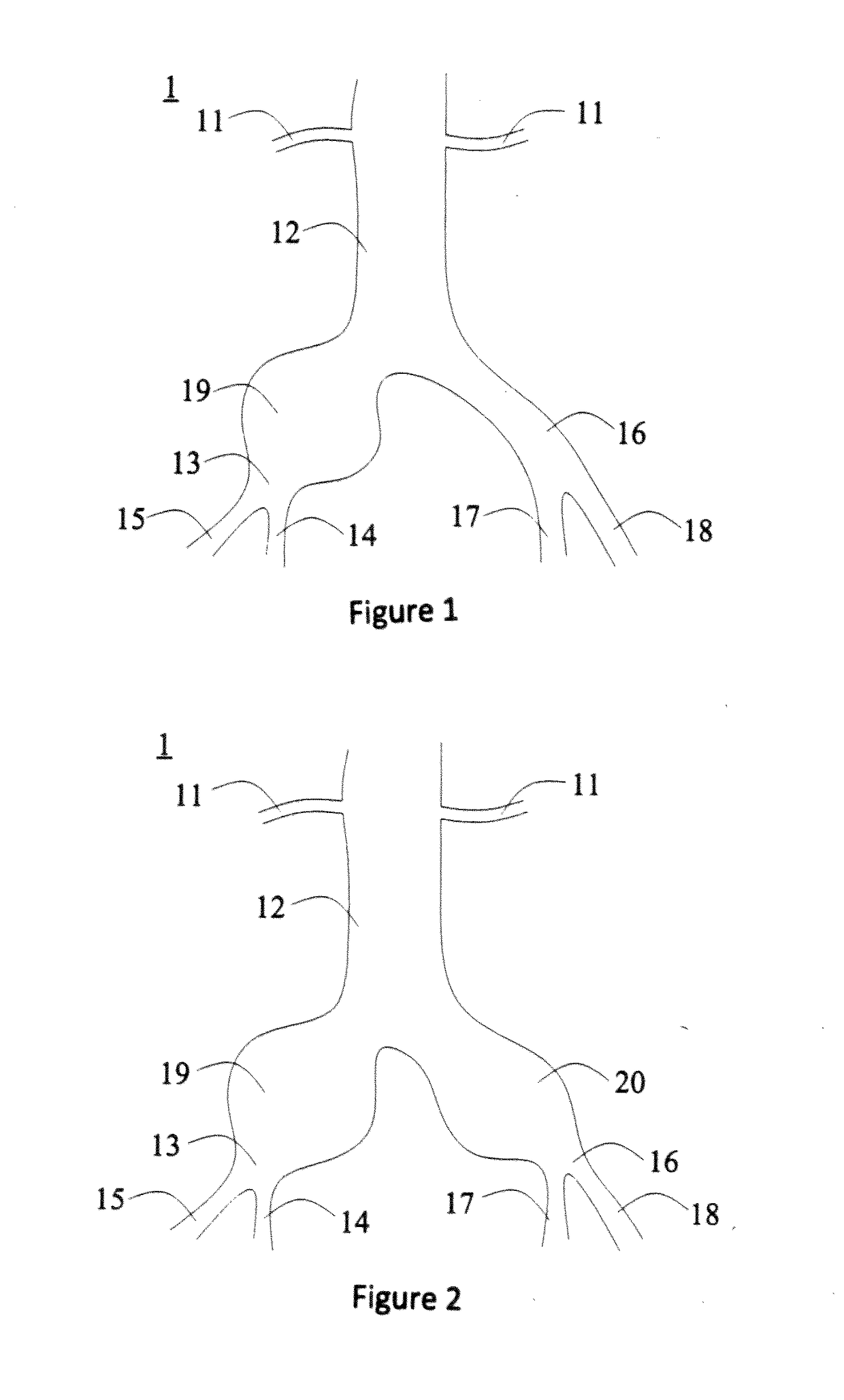 Fork-Type Covered Stent