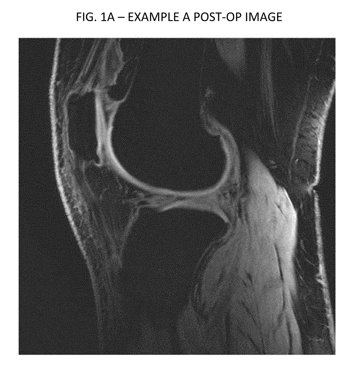 Cartilage repair, preservation and growth by stimulation of bone-chondral interphase and delivery system and methods therefor