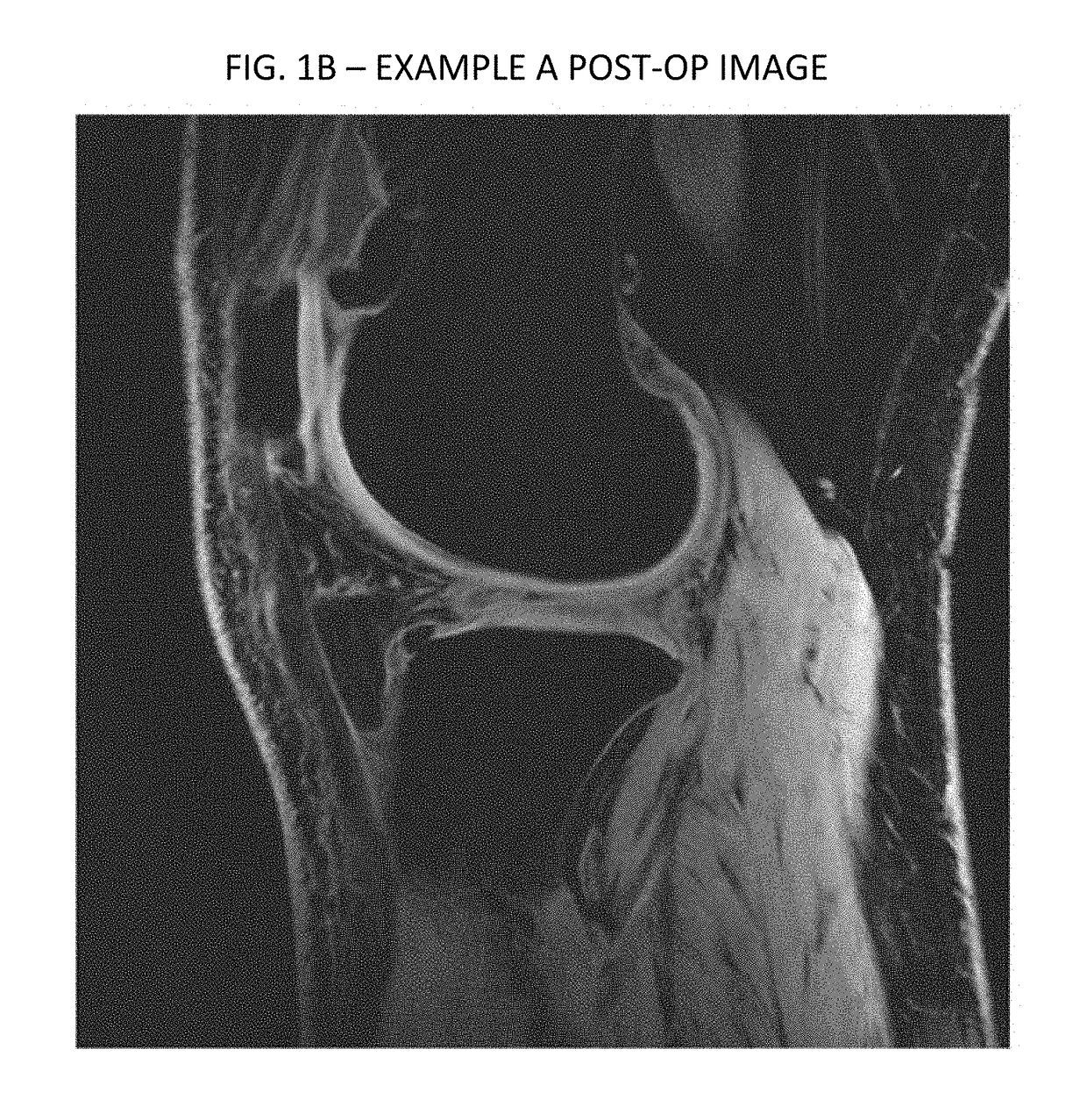 Cartilage repair, preservation and growth by stimulation of bone-chondral interphase and delivery system and methods therefor