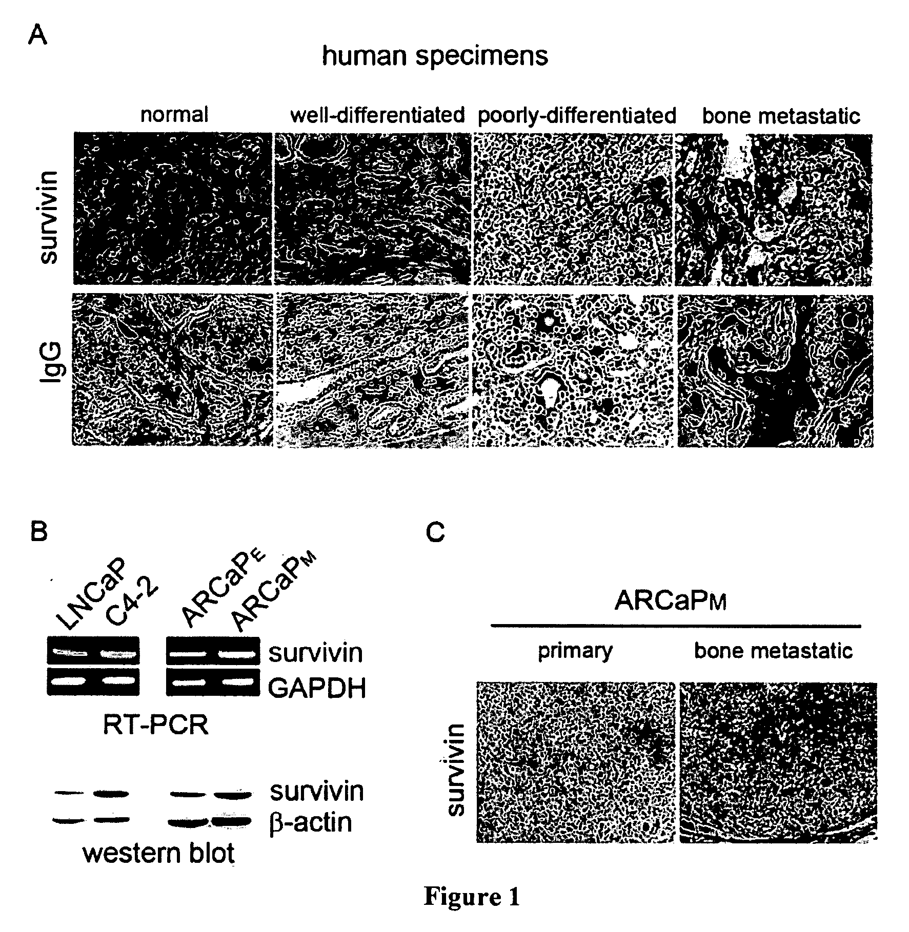 Compositions and methods for treating bone cancer