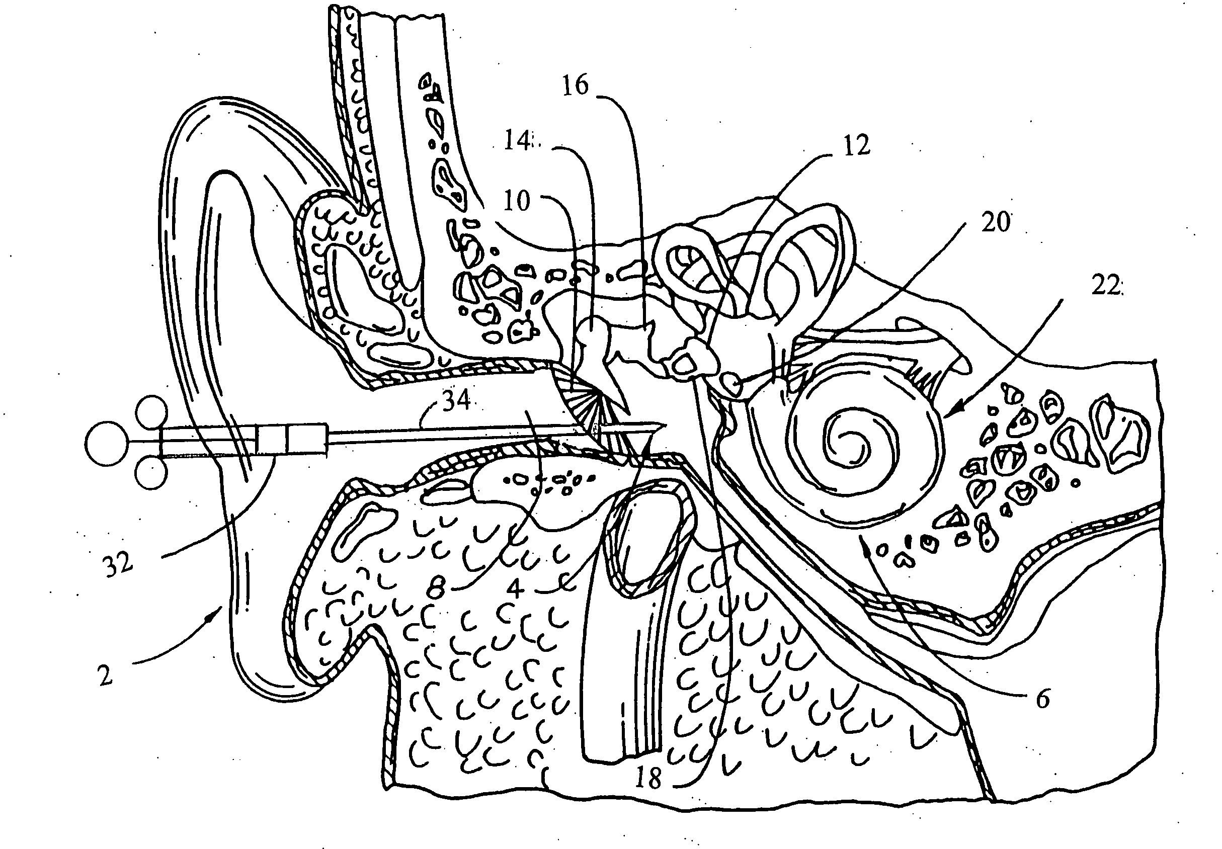 Otologic nanotechnology