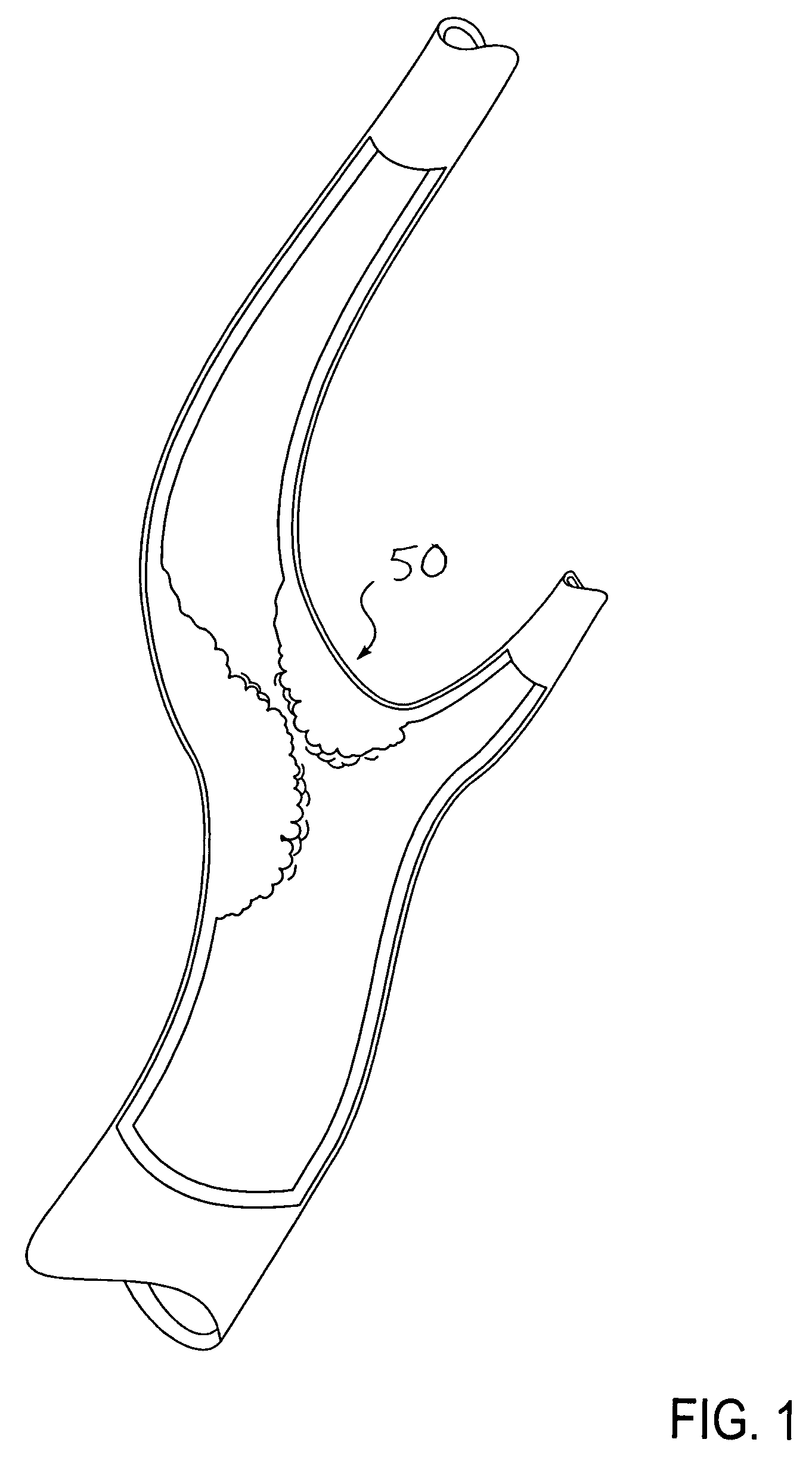 Method of performing protected angioplasty and stenting at a carotid bifurcation