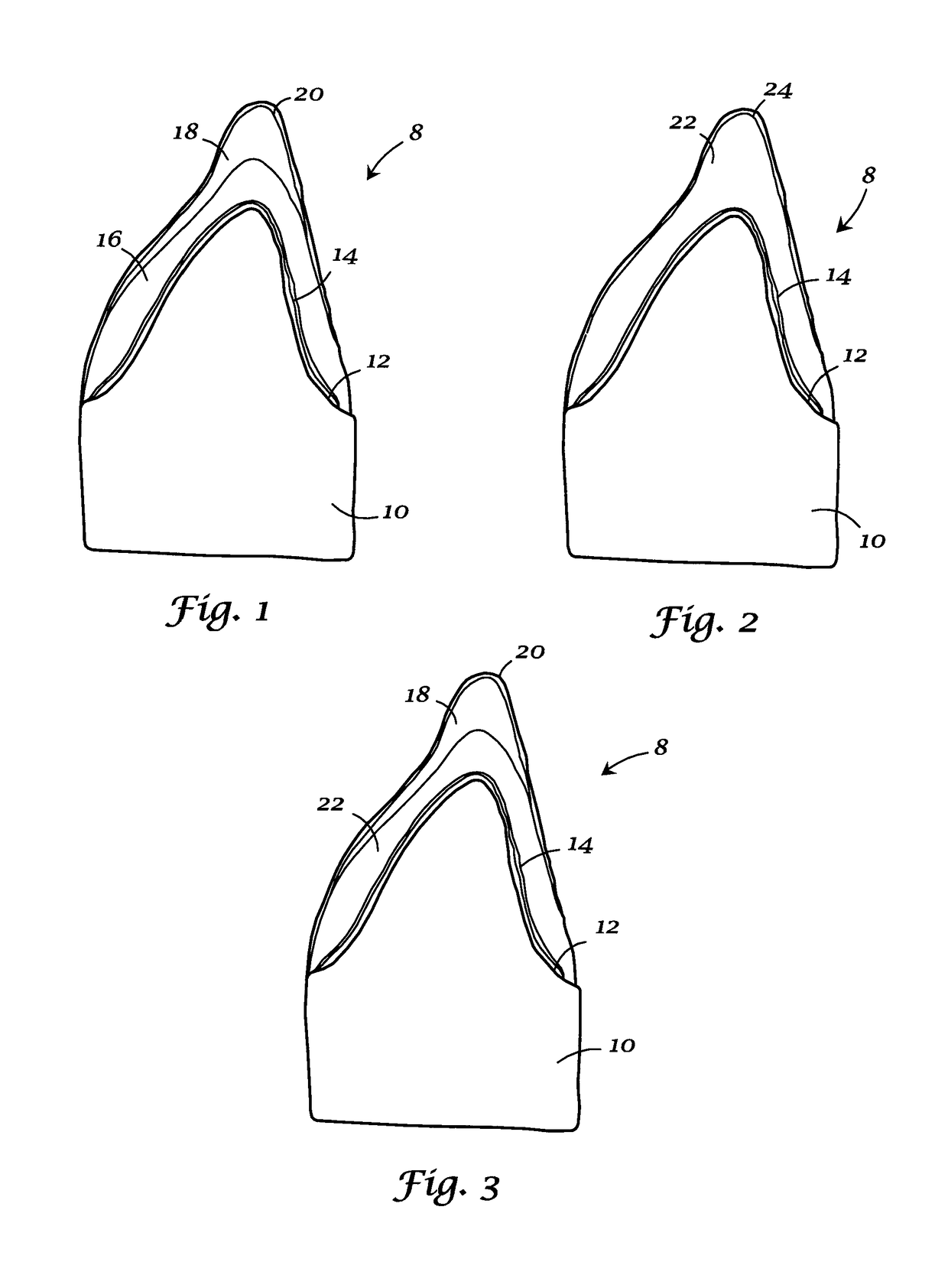 Integrated porcelain system for a dental prosthesis