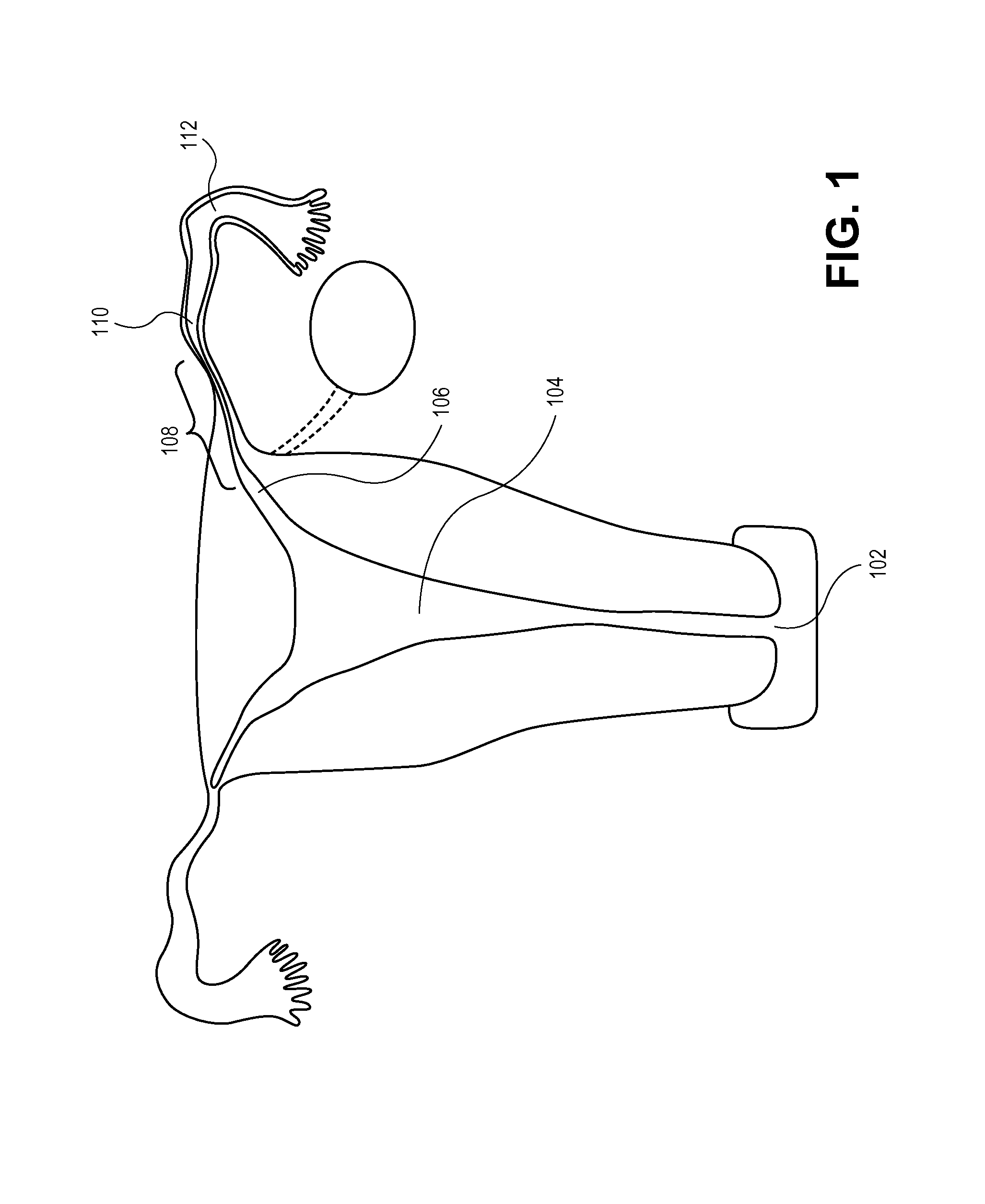 Occlusion device with openable channel