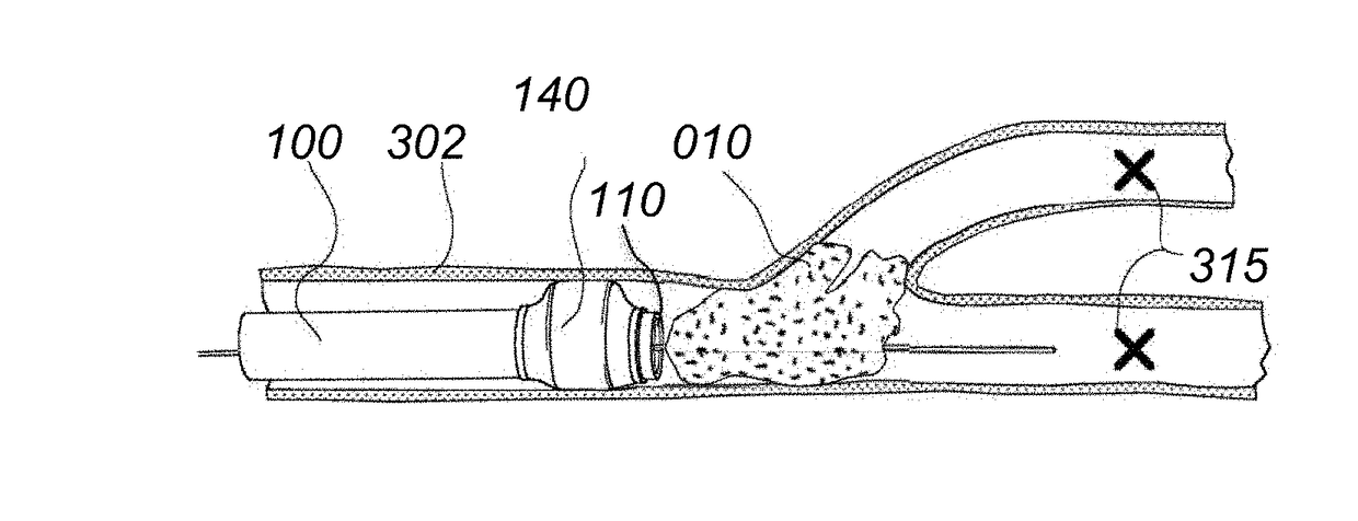 Methods of use of a balloon-tip aspiration catheter for ischemic stroke interventions