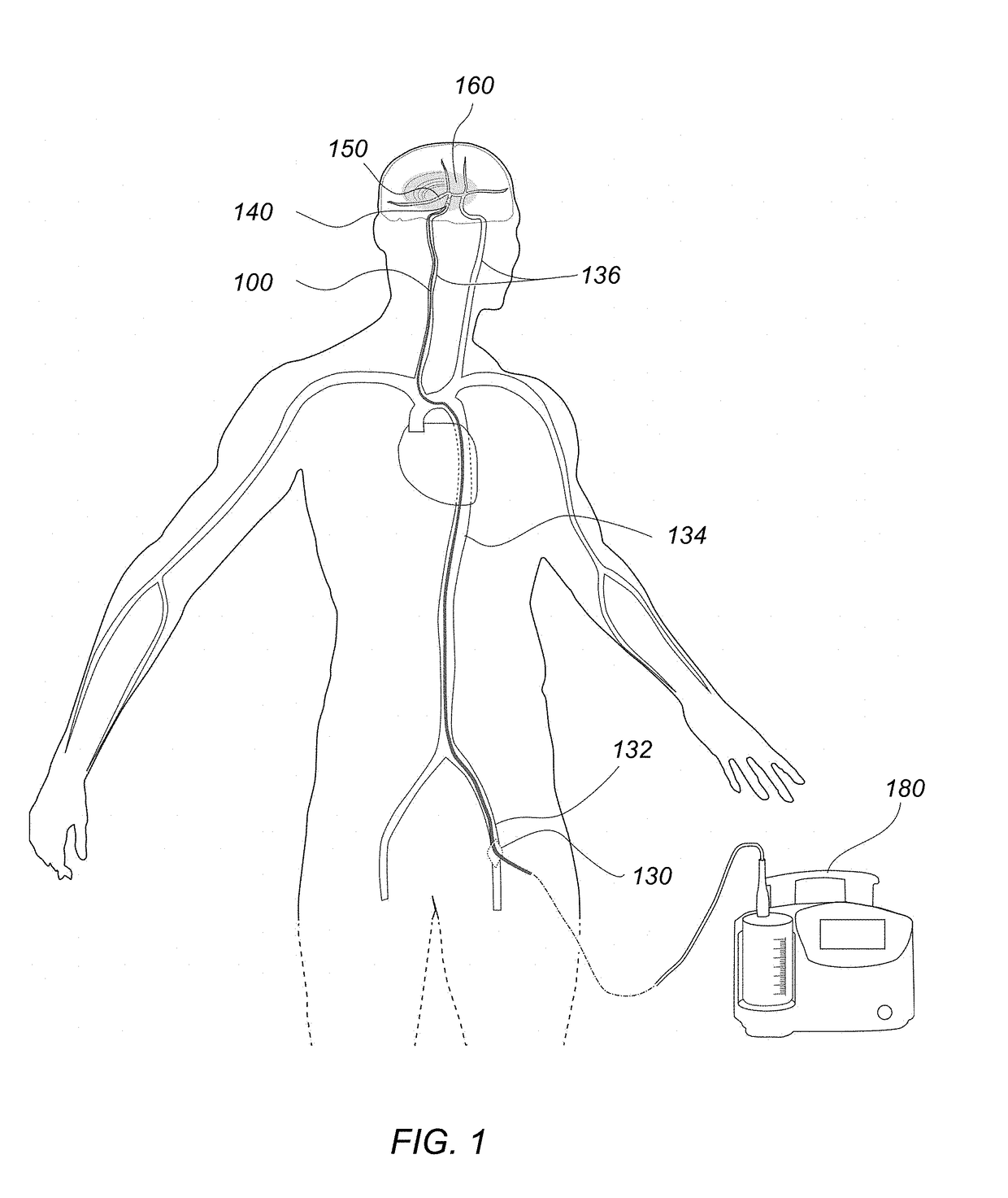 Methods of use of a balloon-tip aspiration catheter for ischemic stroke interventions