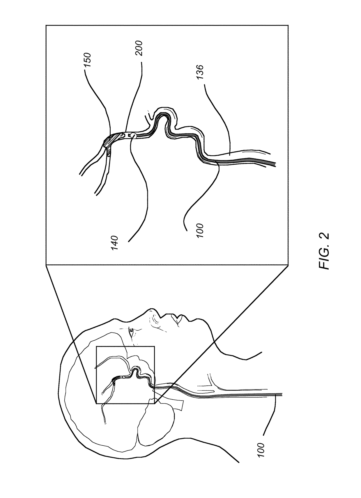 Methods of use of a balloon-tip aspiration catheter for ischemic stroke interventions