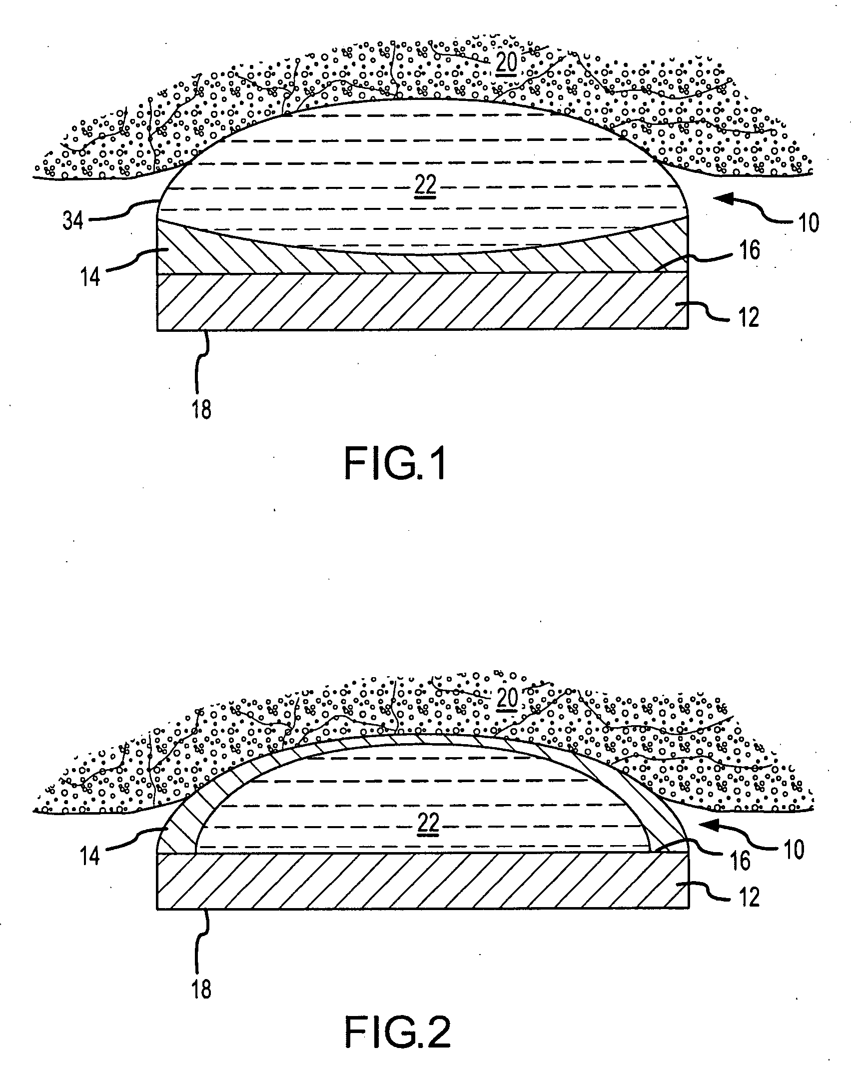 Device and method for high intensity focused ultrasound ablation with acoustic lens