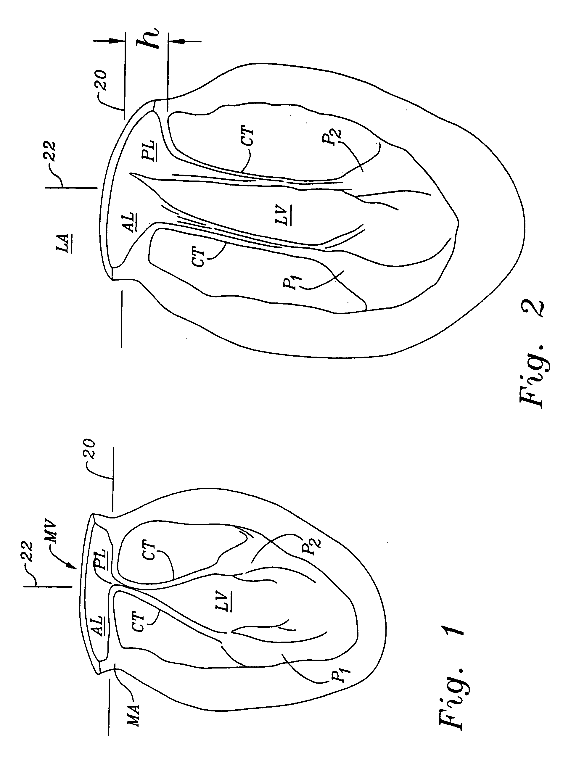 Mitral valve annuloplasty ring having a posterior bow