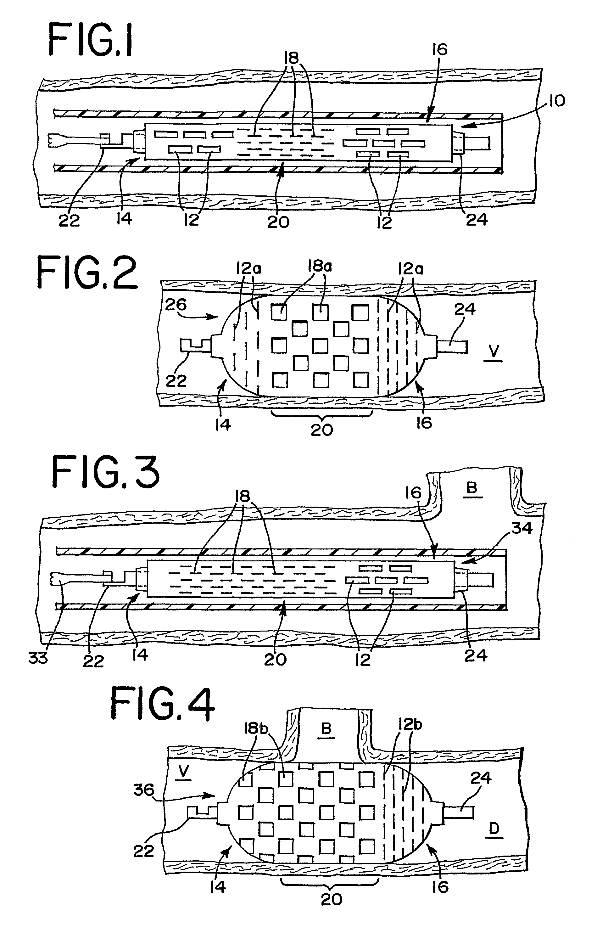 Thin film devices for temporary or permanent occlusion of a vessel