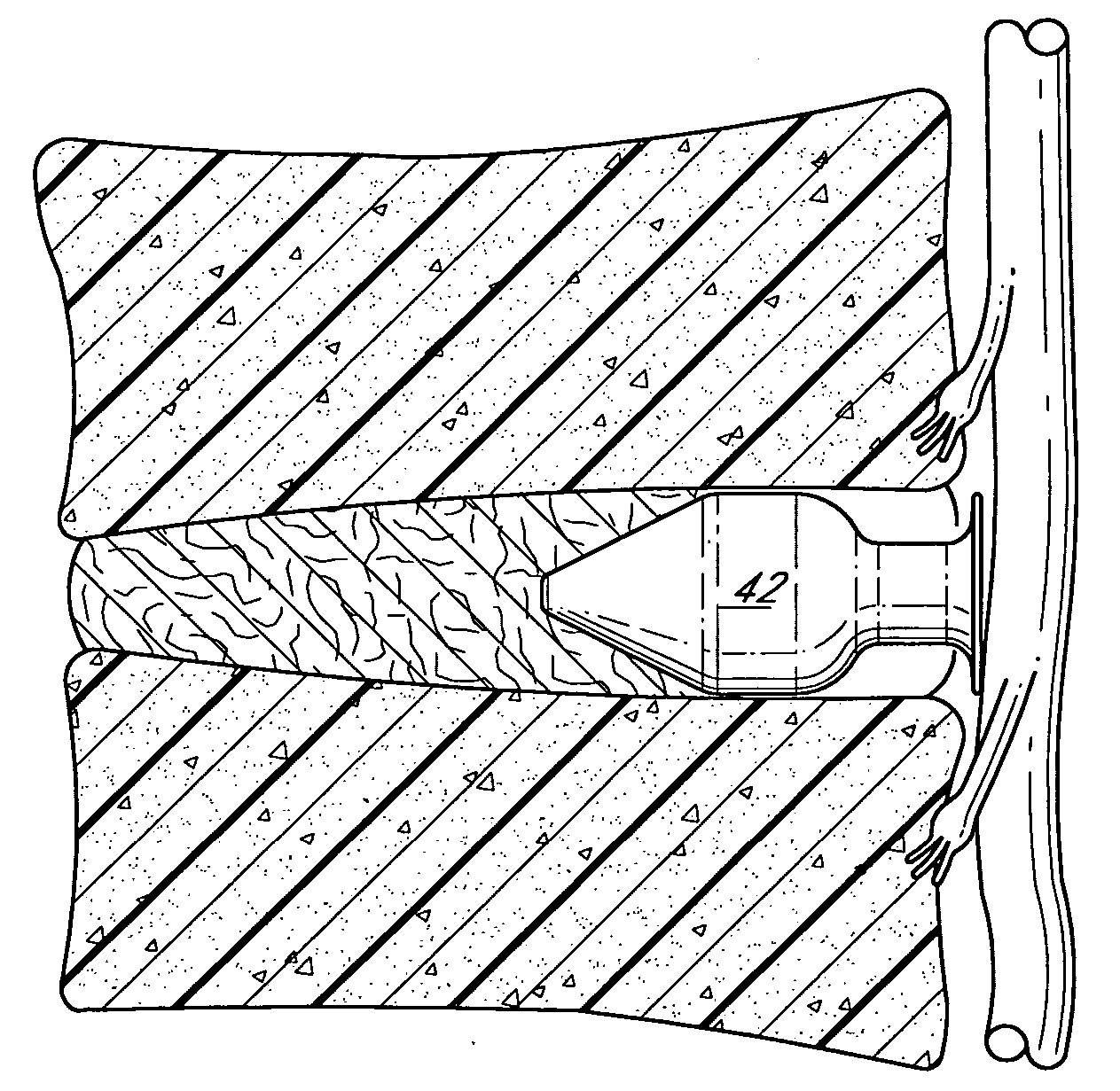 Spinal implants and methods of providing dynamic stability to the spine