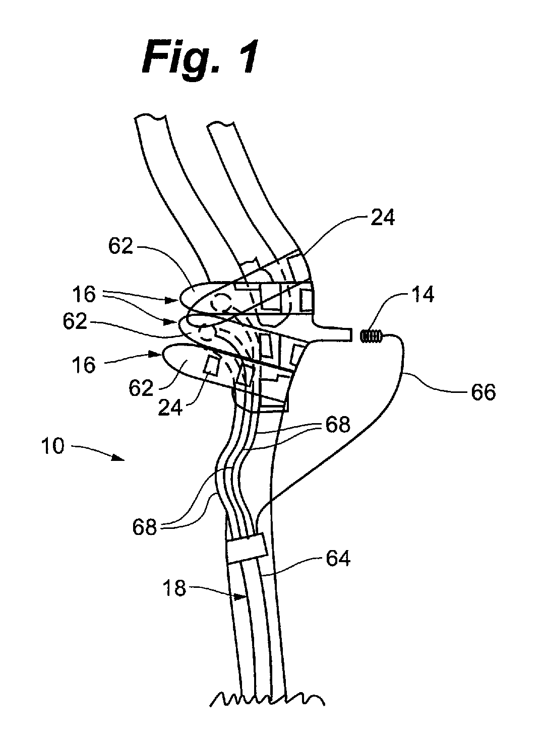 Method and system for implantable pressure transducer for regulating blood pressure