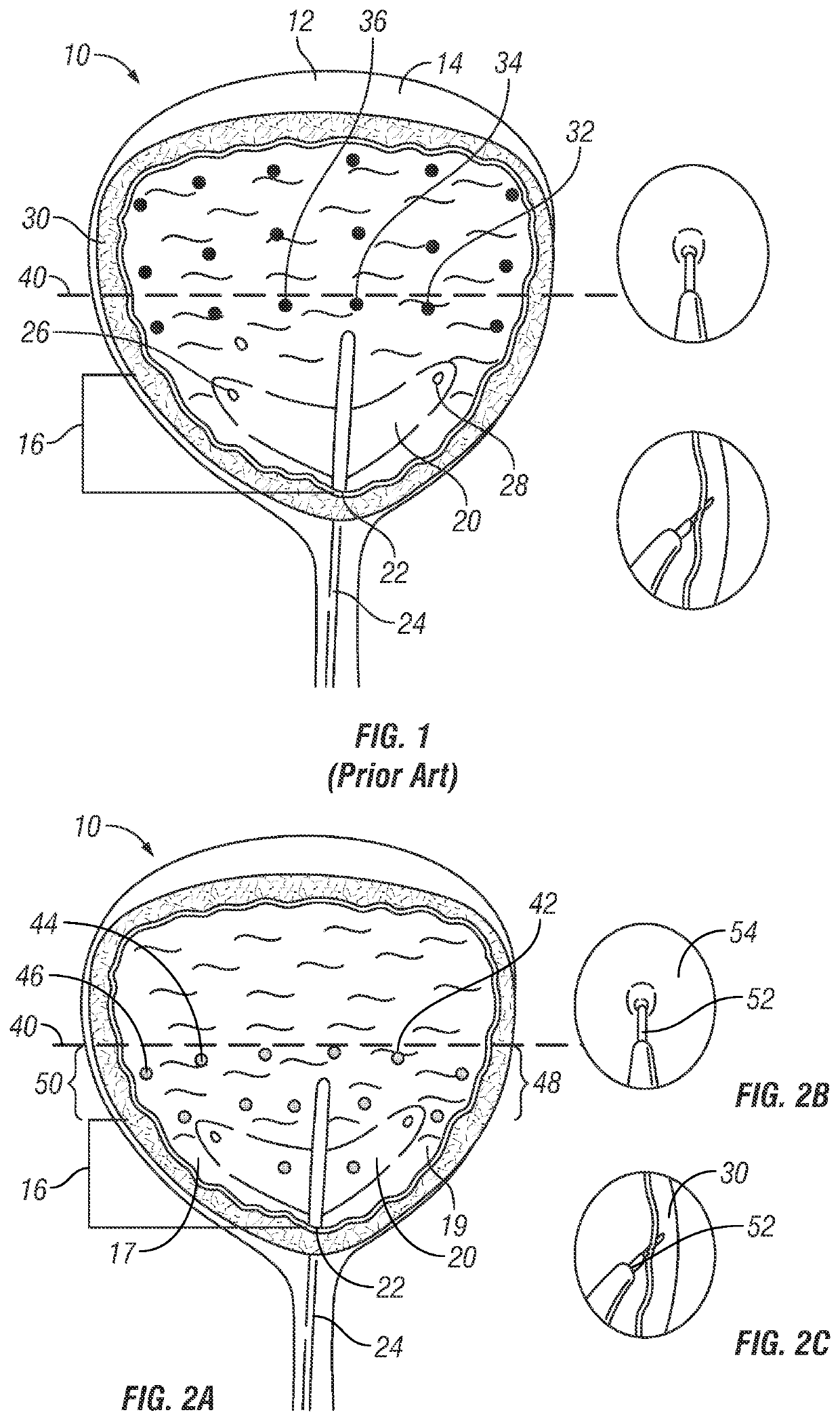 Bladder injection paradigm for administration of botulinum toxins