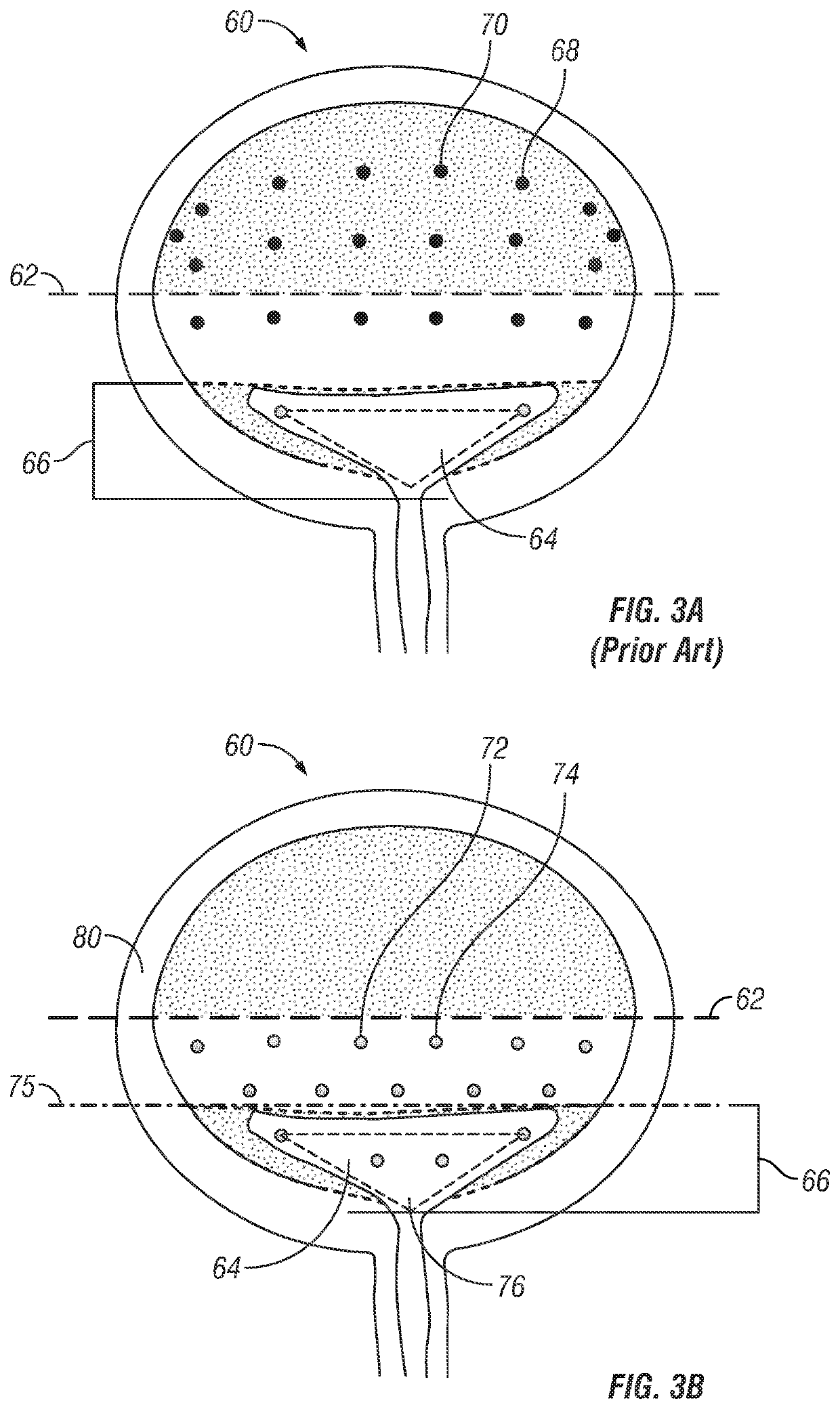 Bladder injection paradigm for administration of botulinum toxins