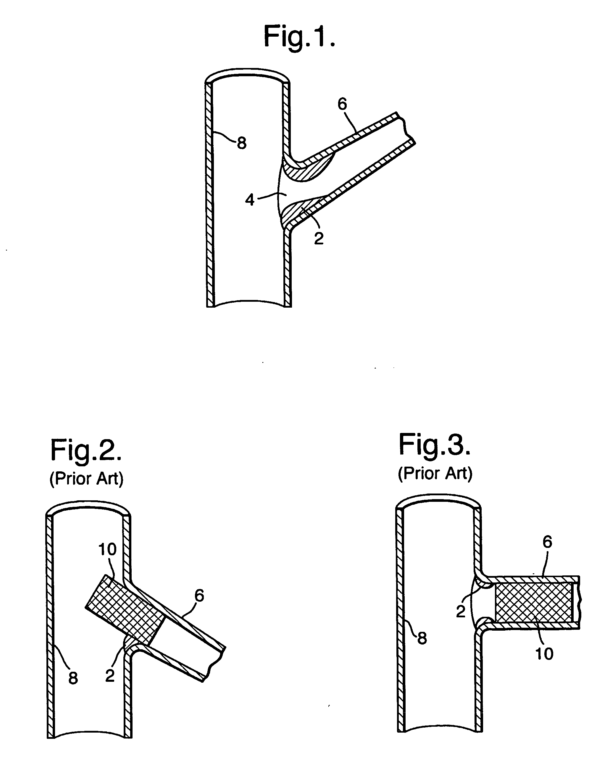 Stent positioning system