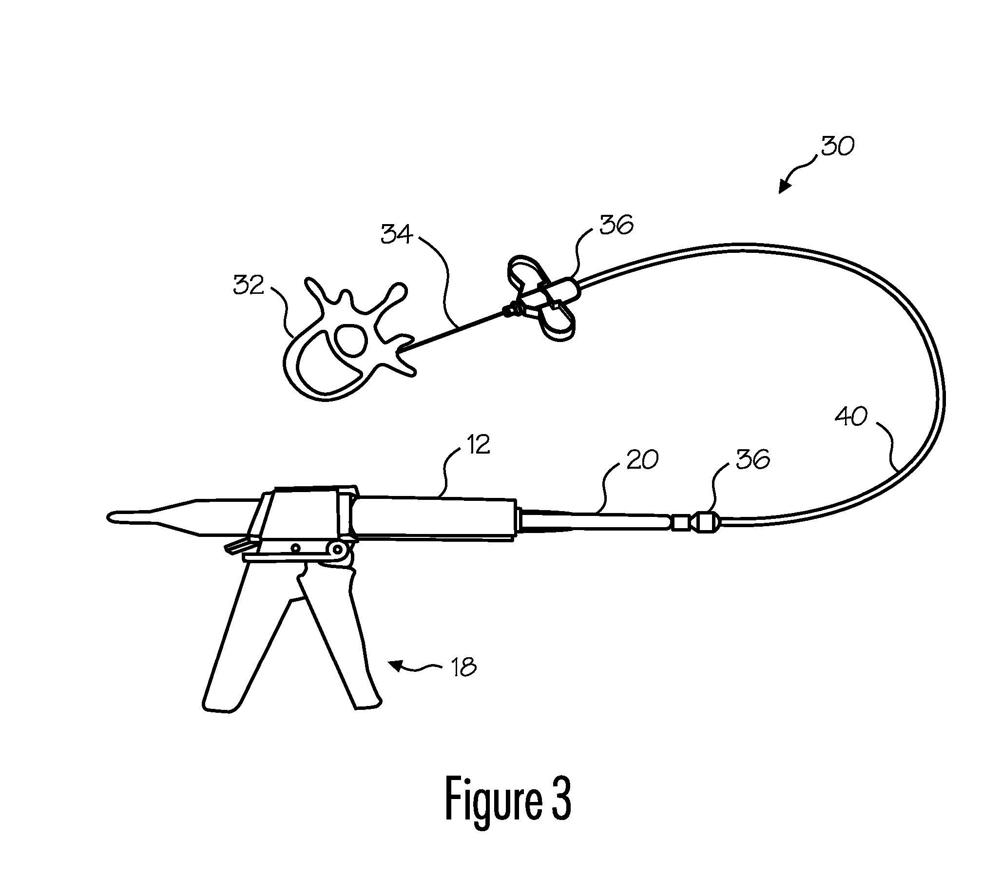 Materials and apparatus for in-situ bone repair