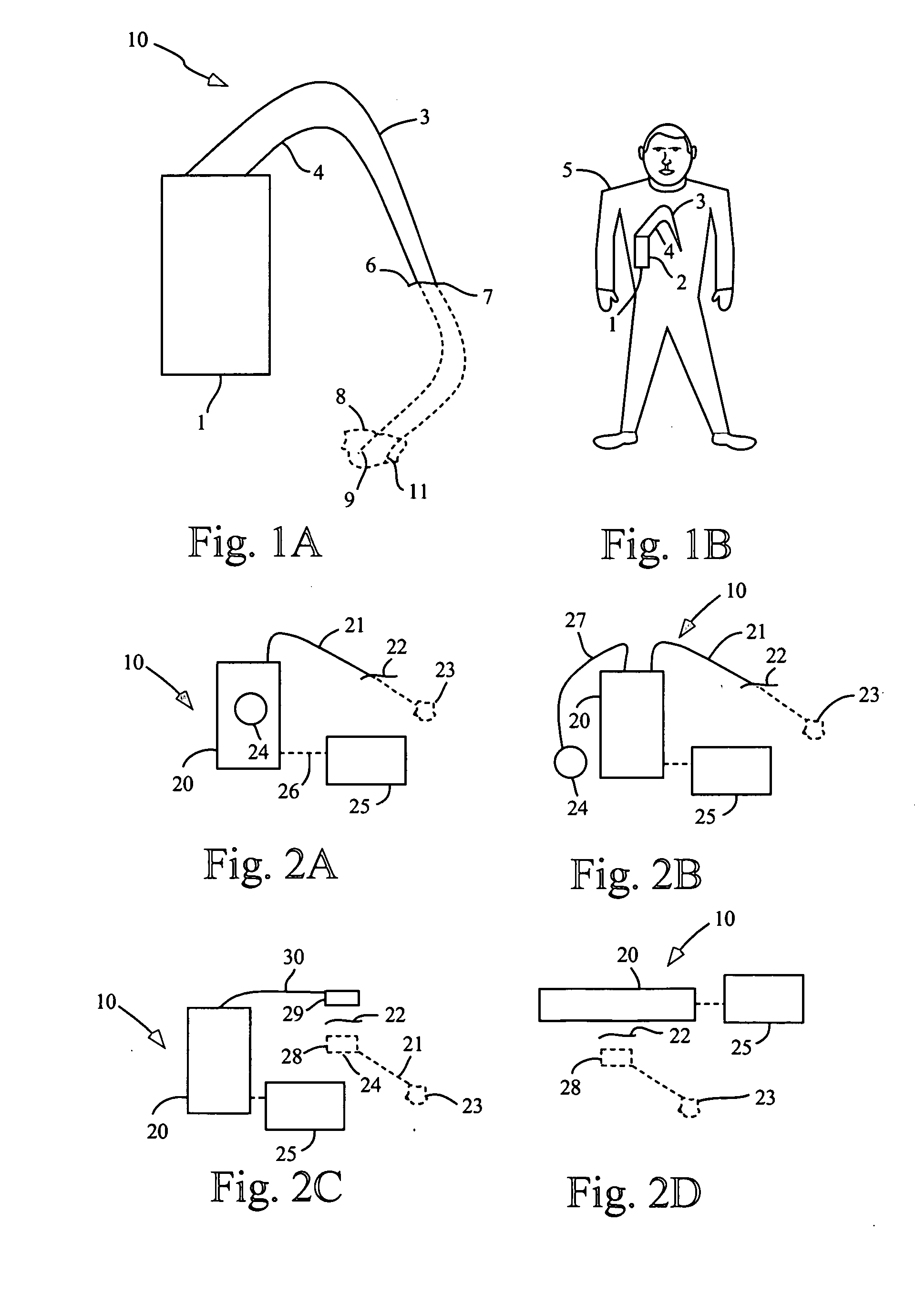 Partially implantable system for the electrical treatment of cancer