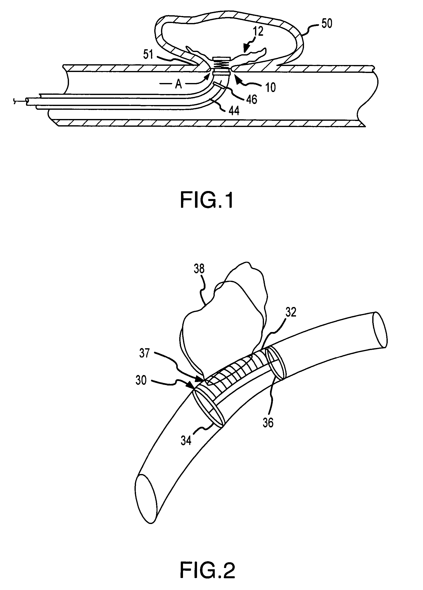 Aneurysm stent with growth factor