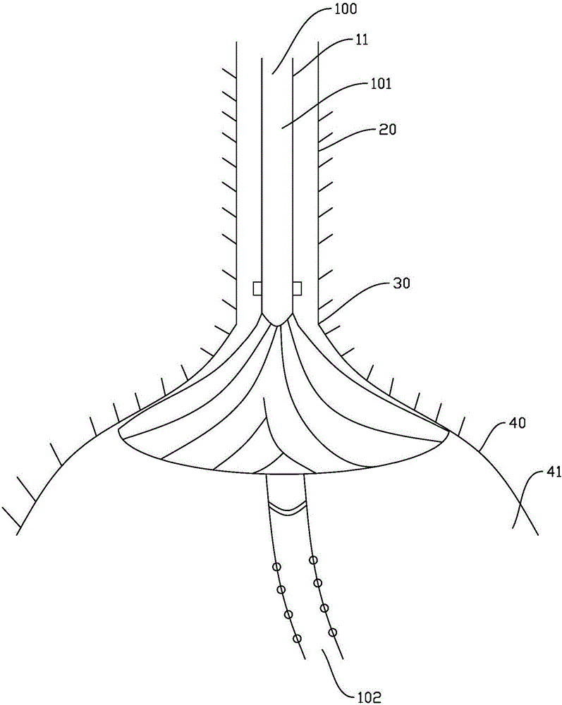 Stomach tube and nasal feeding device