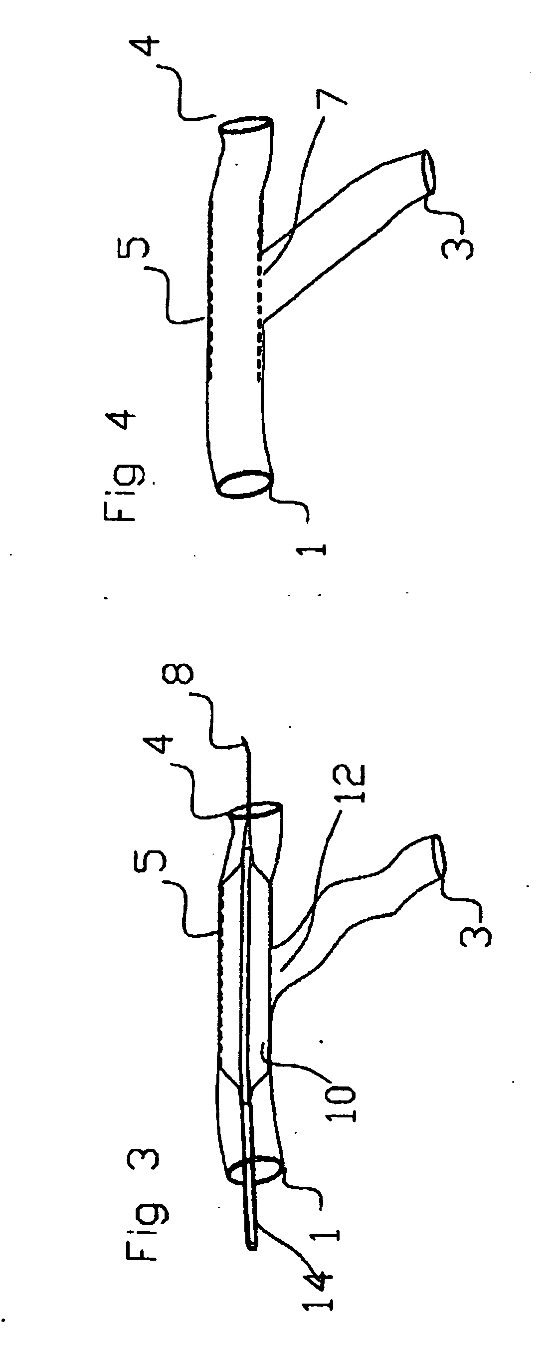 Catheter device for delivery of stents to bifurcated arteries