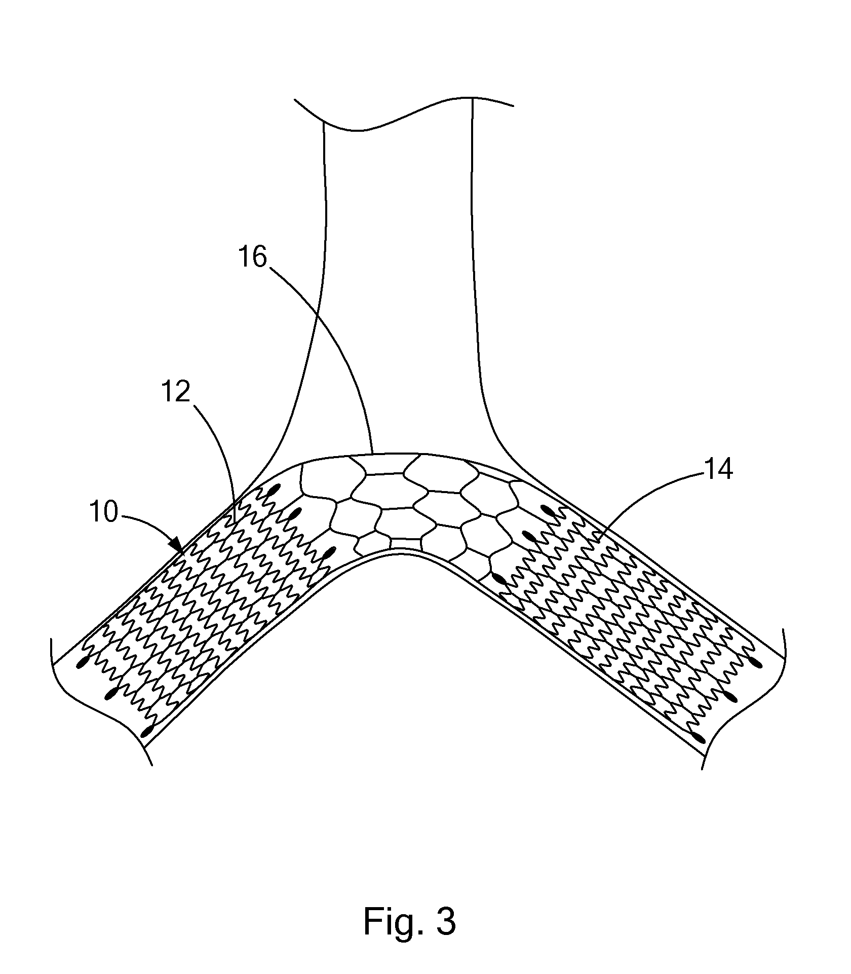 Frame-based vena cava filter