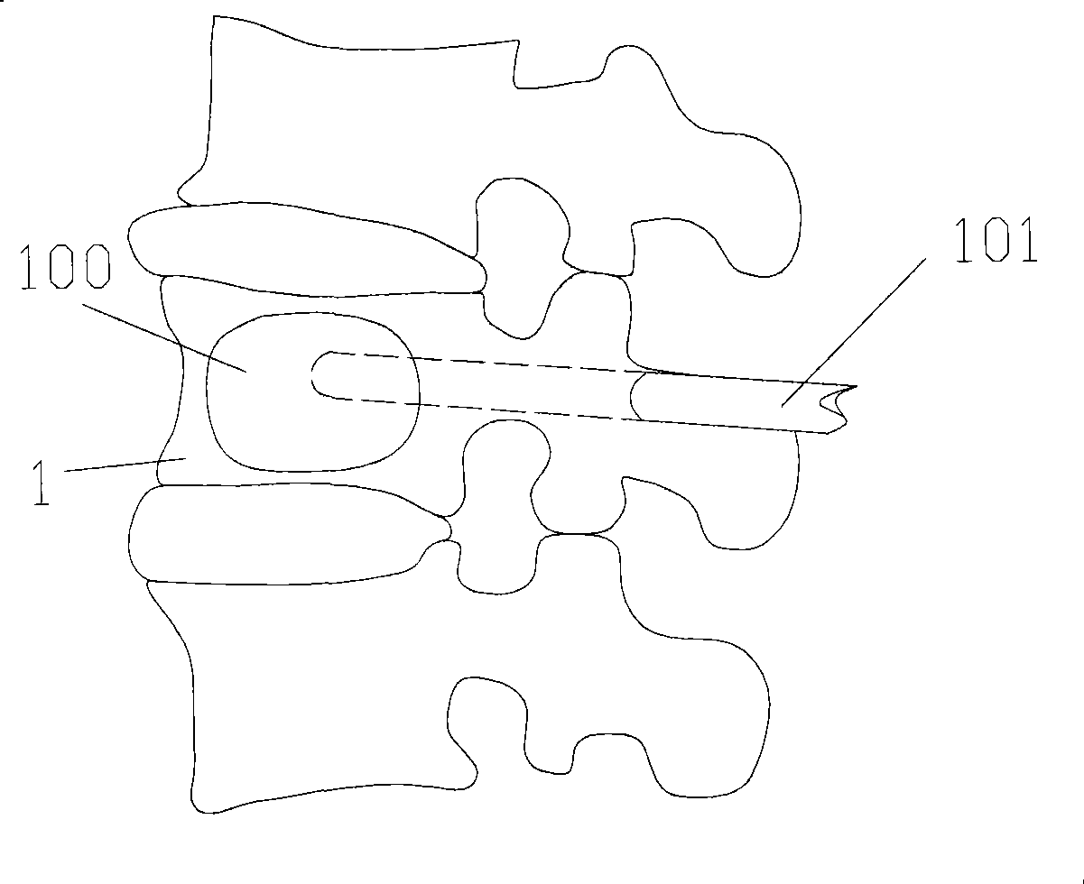 Oriented dilatation balloon and oriented dilatation device