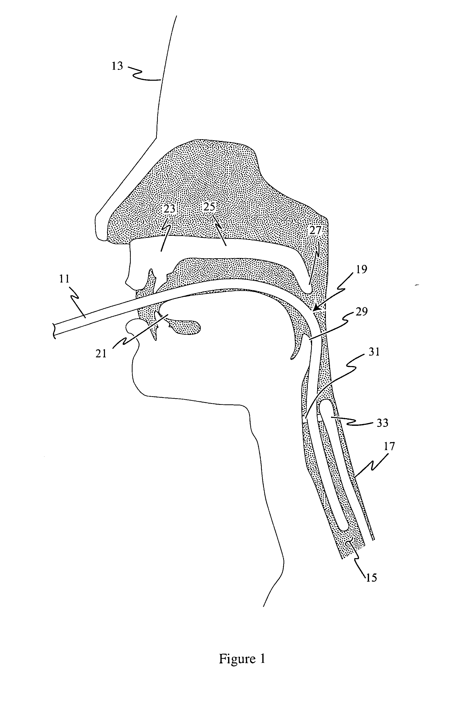 Endotracheal tube and stylet