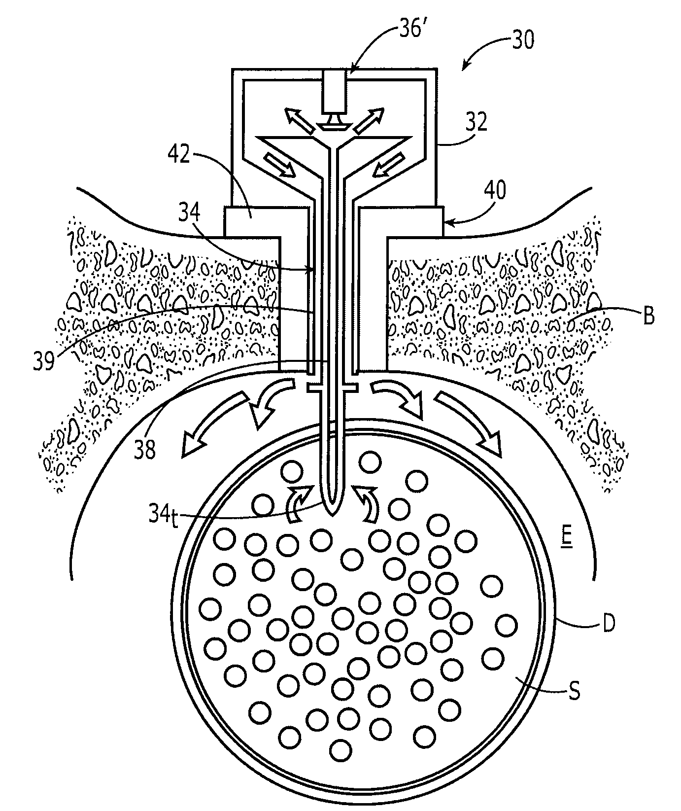 Subarachnoid epidural shunt