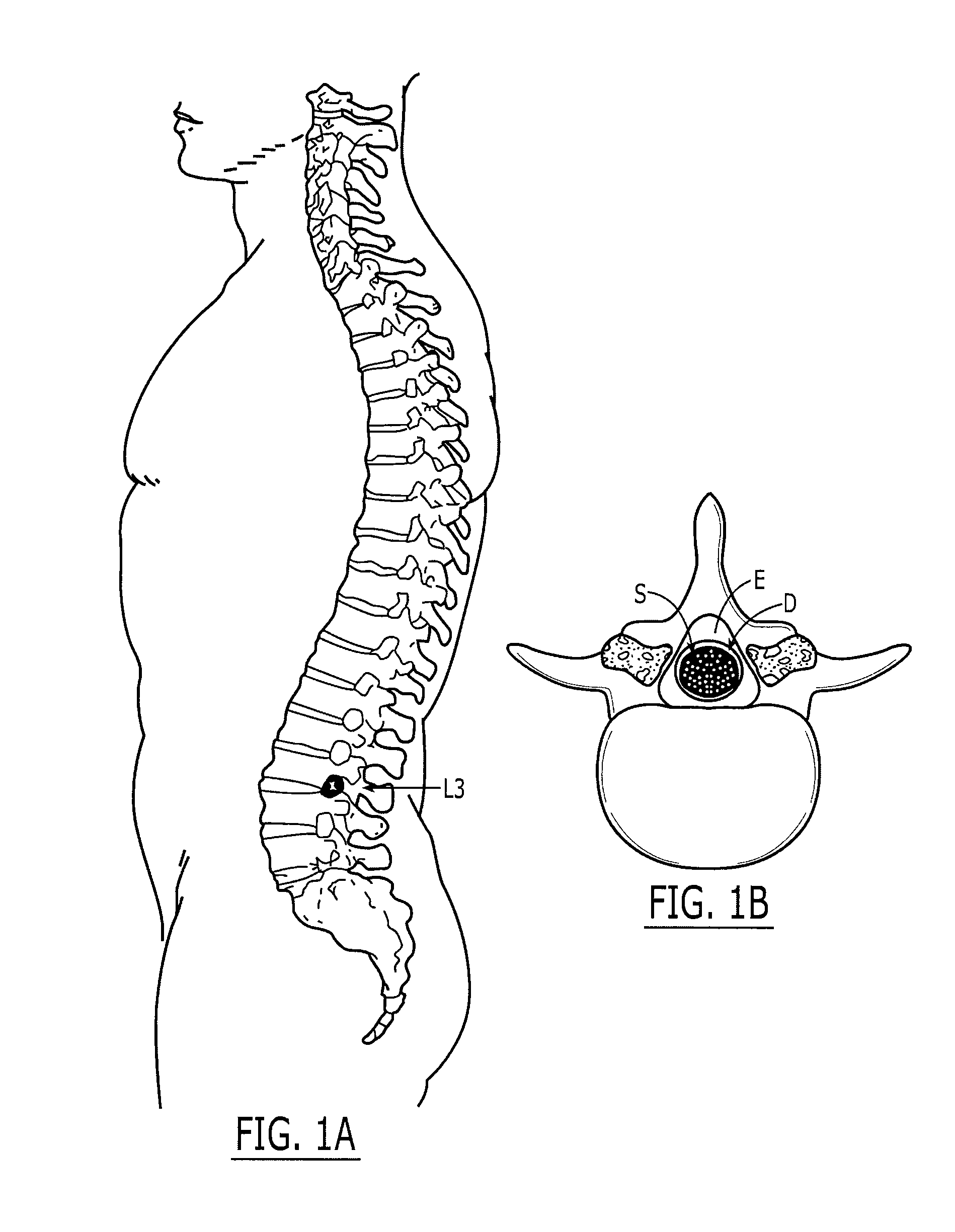 Subarachnoid epidural shunt