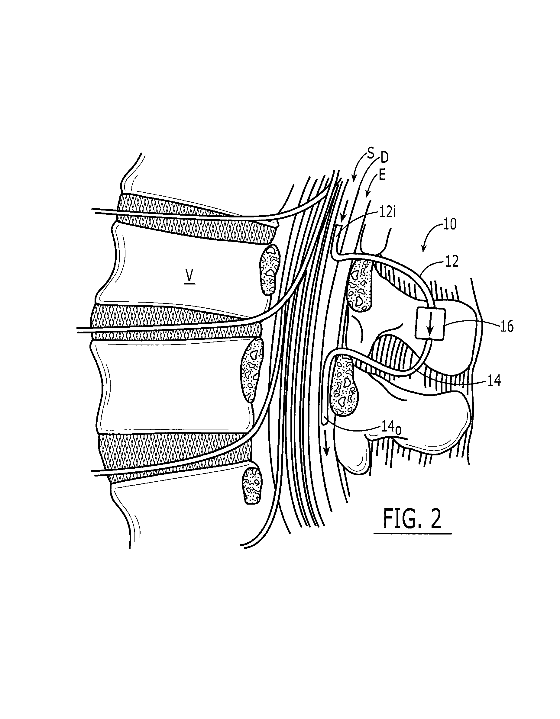 Subarachnoid epidural shunt