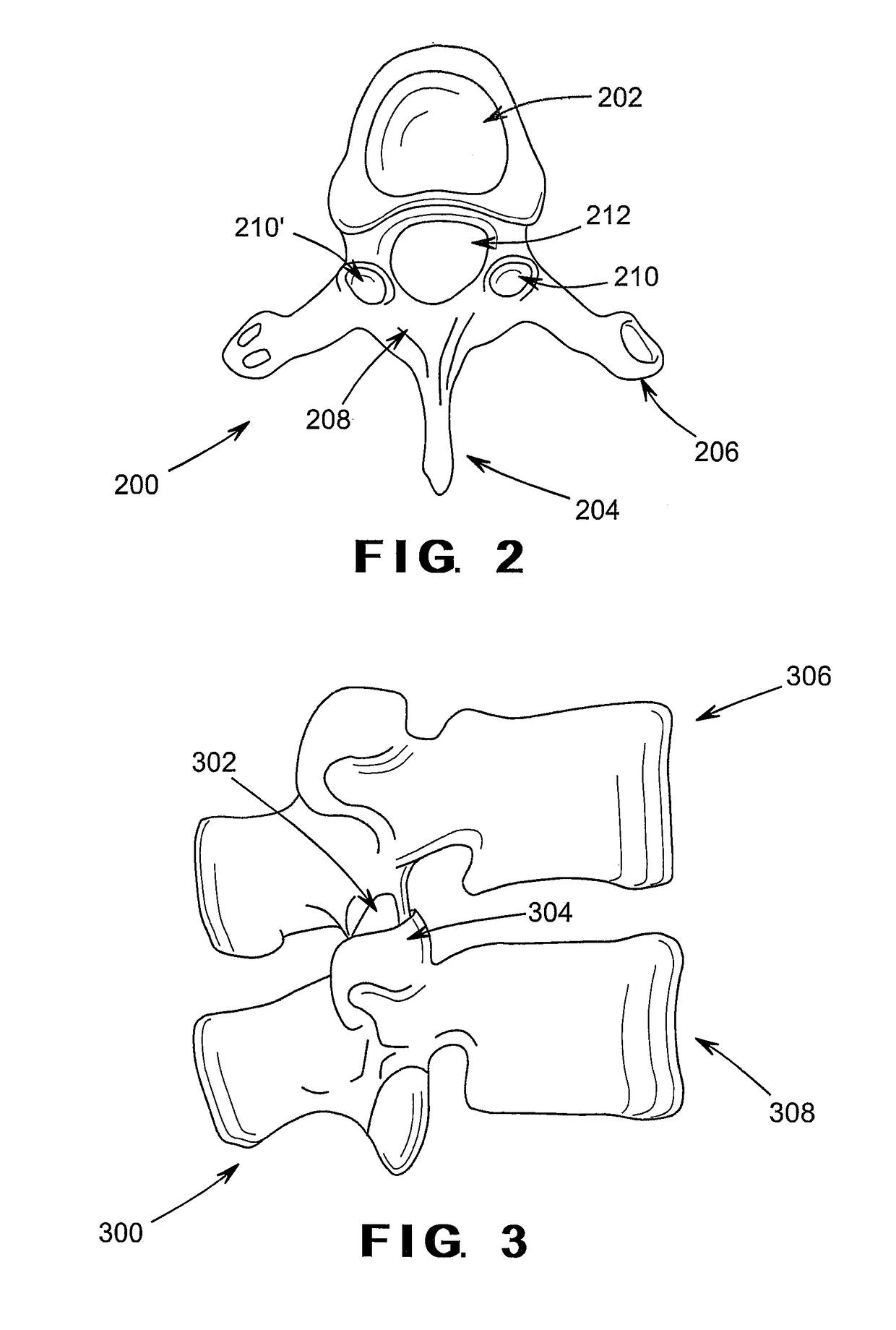 Devices and method for treatment of spondylotic disease