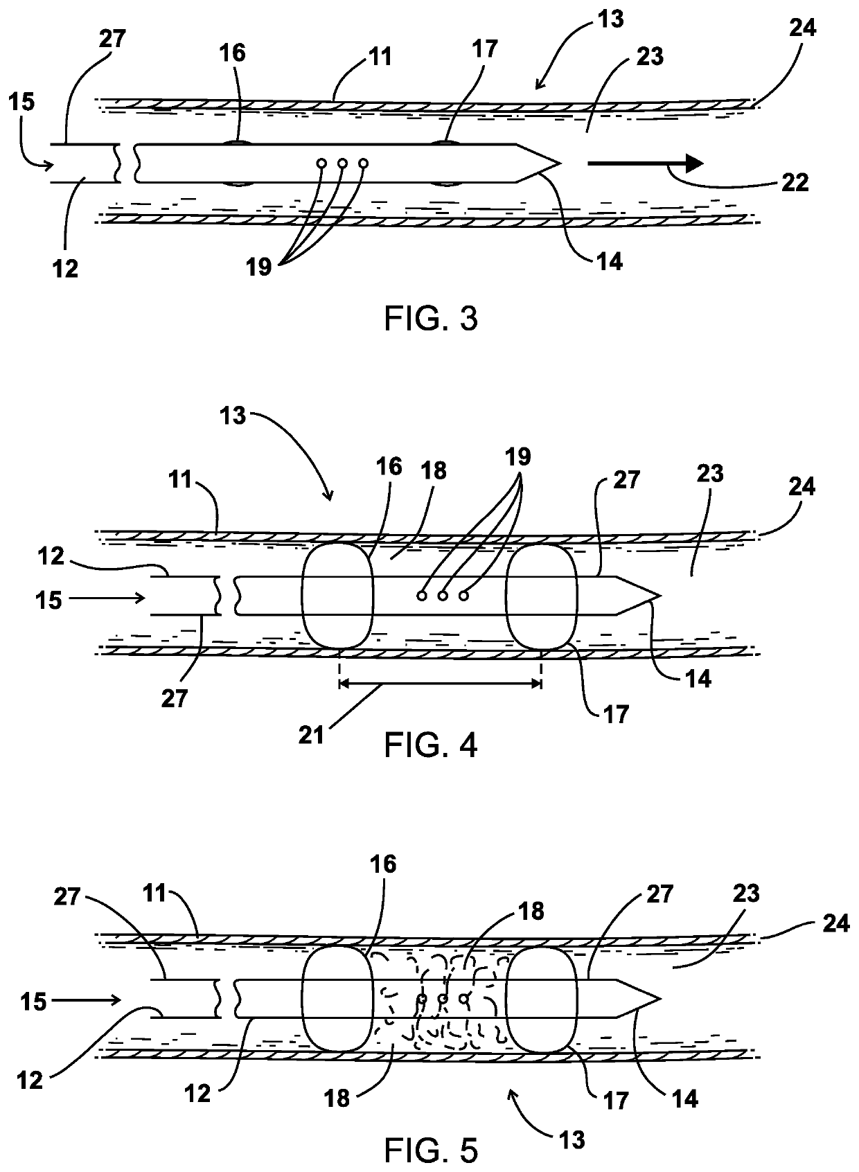 Method and apparatus for enhancing the maturation rate of an arteriovenous fistula