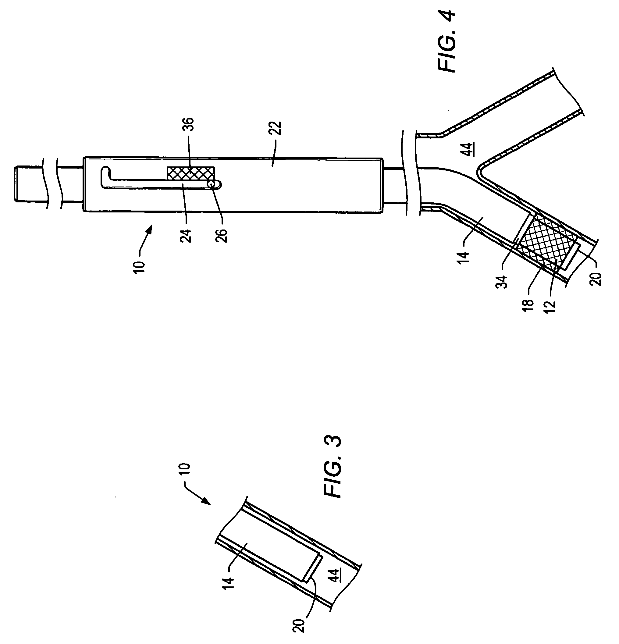 Stent delivery system and method of use