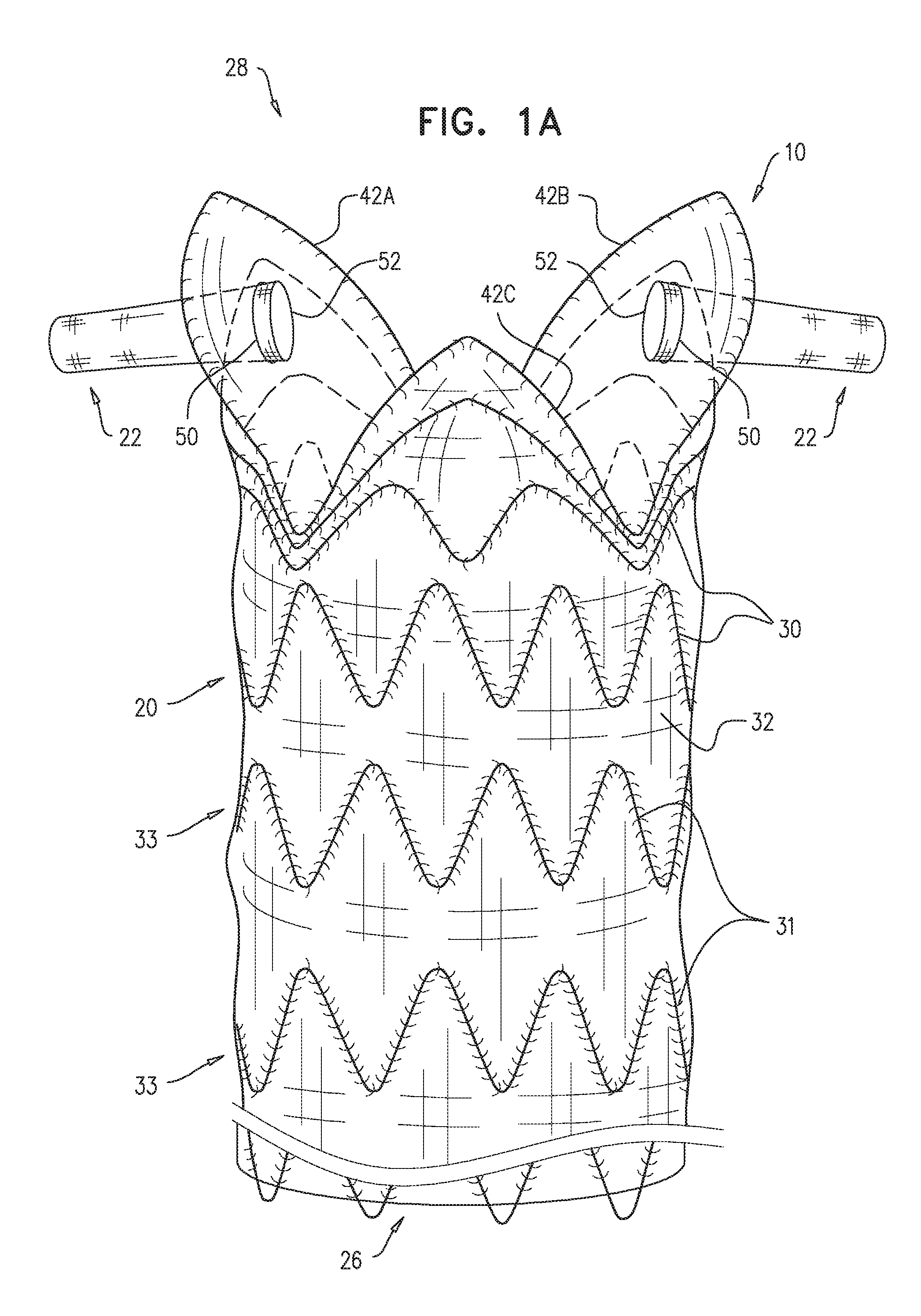 Ascending aorta stent-graft system