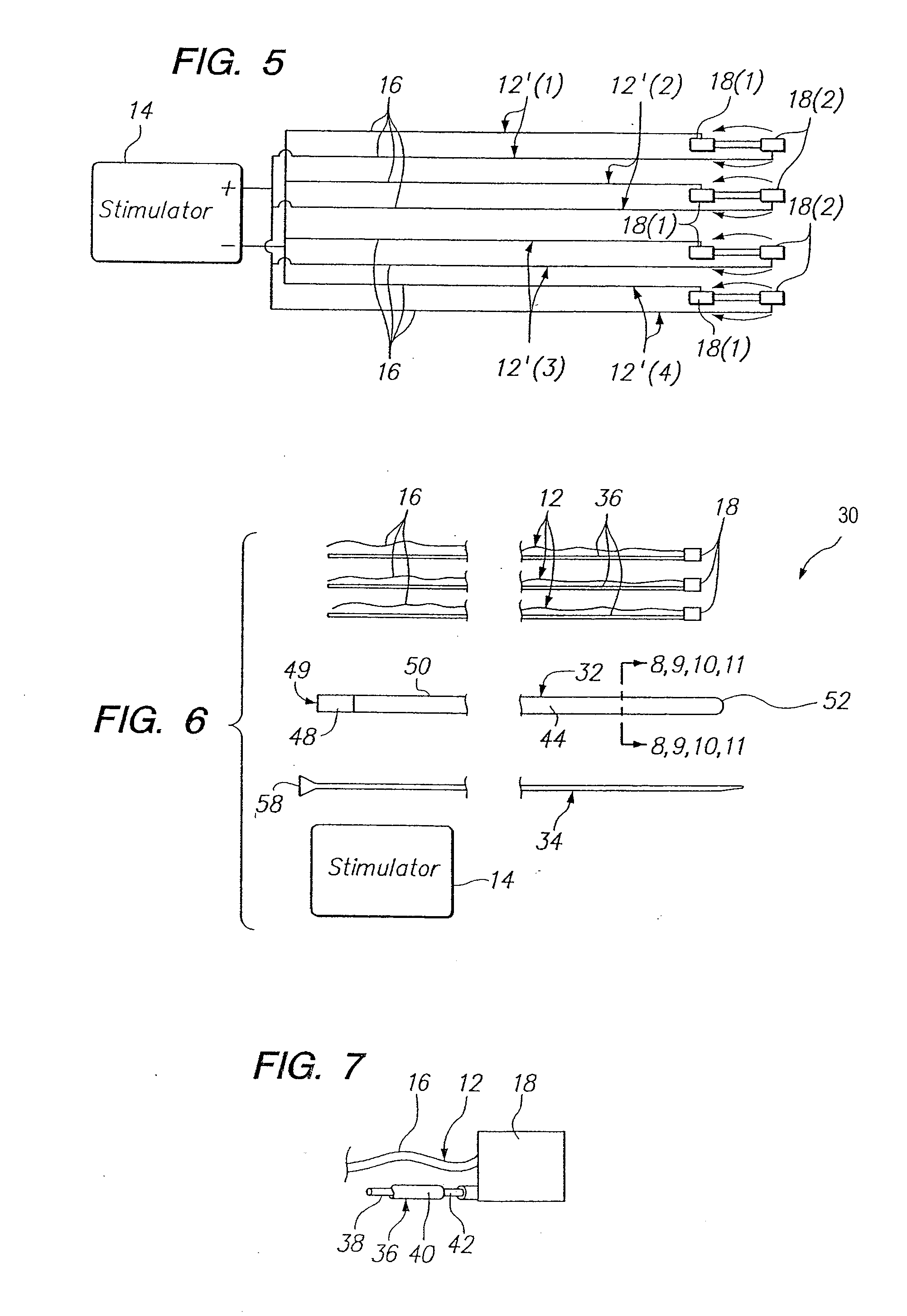 Method of intravascularly delivering stimulation leads into brain to stimulate the spg