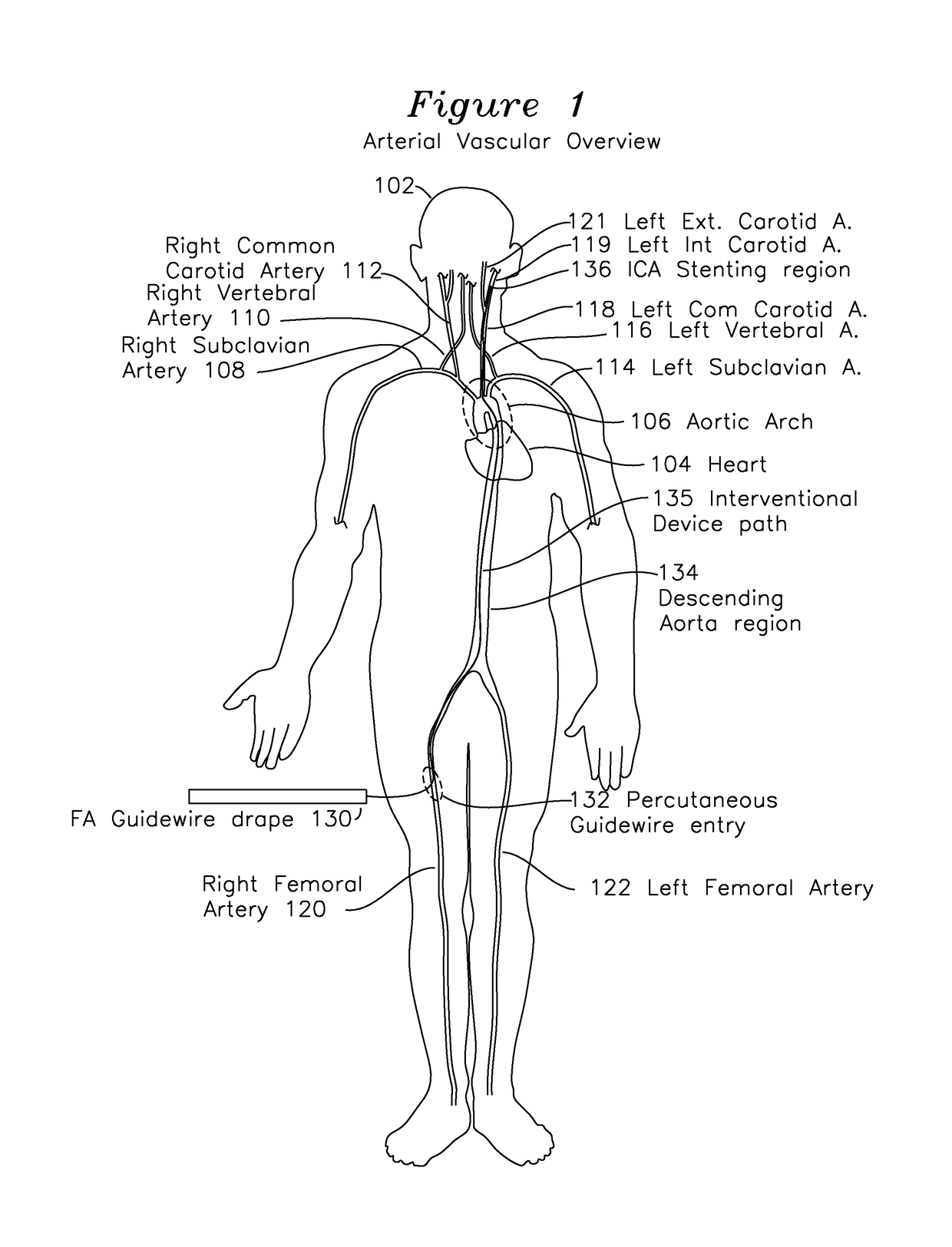 Method and apparatus for percutaneous superficial temporal artery access for carotid artery stenting