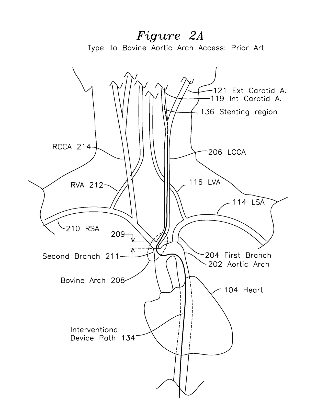 Method and apparatus for percutaneous superficial temporal artery access for carotid artery stenting