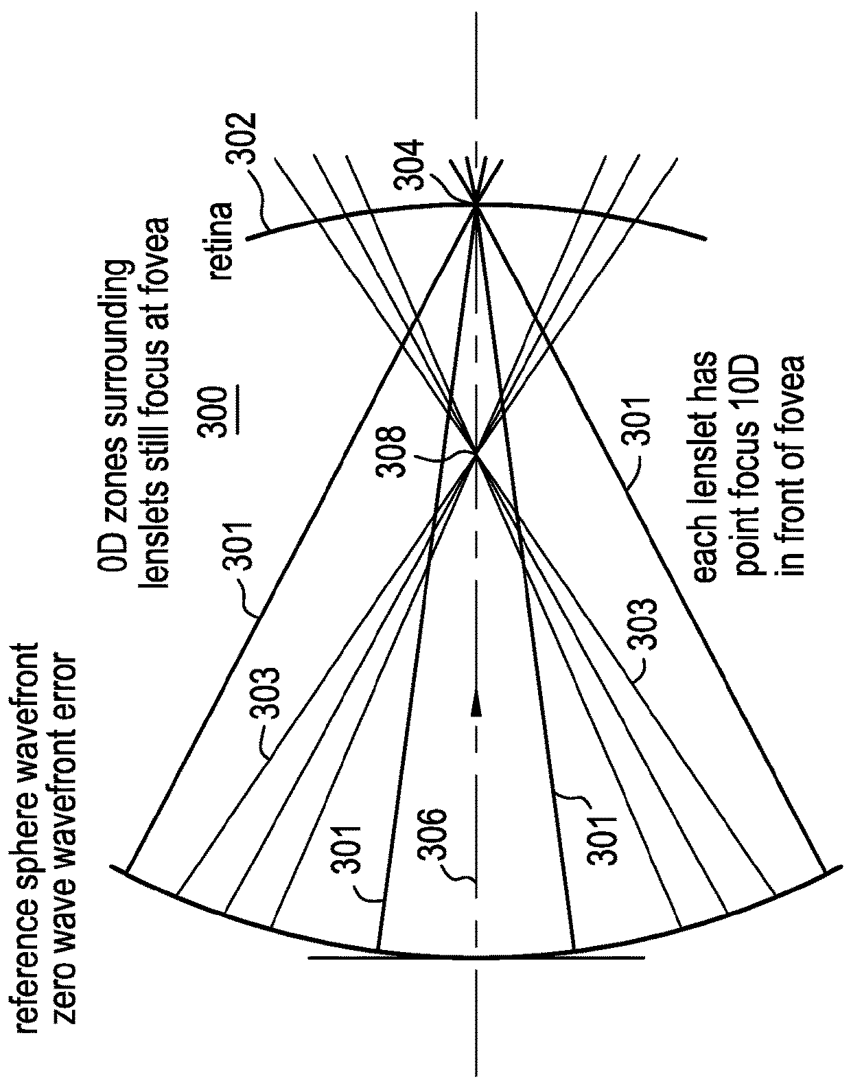 Ophthalmic lens comprising lenslets for preventing and/or slowing myopia progression