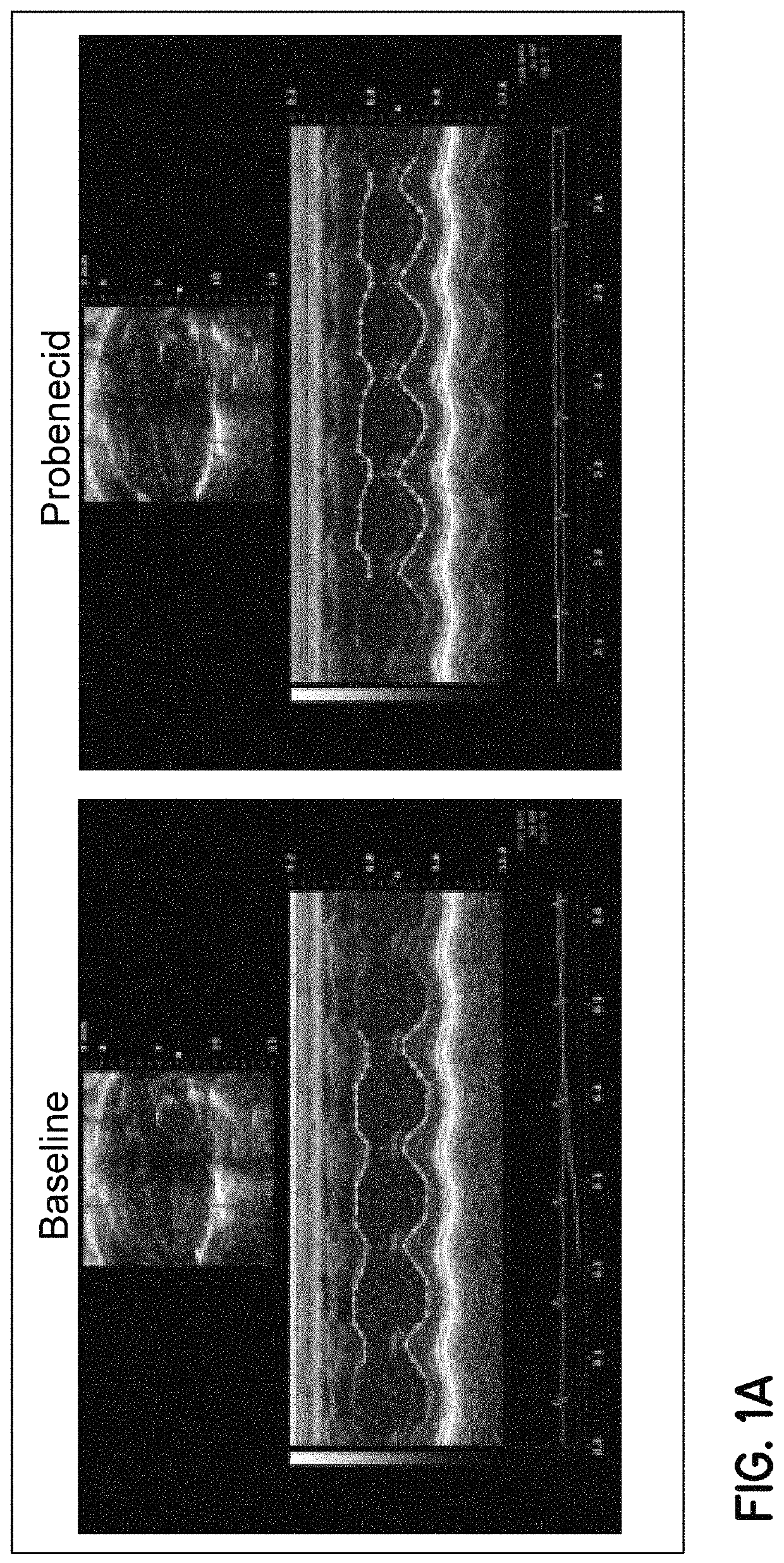 Method of treating acute decompensated heart failure with probenecid