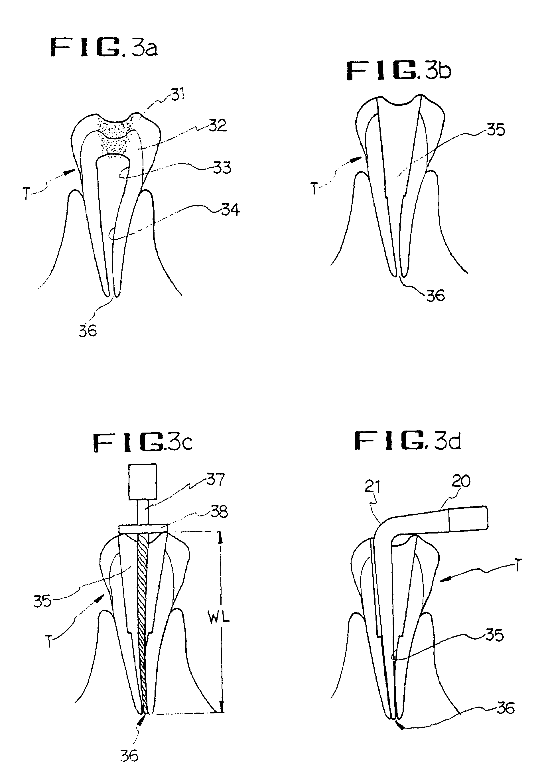 Endodontic gutta-percha point with working length marks