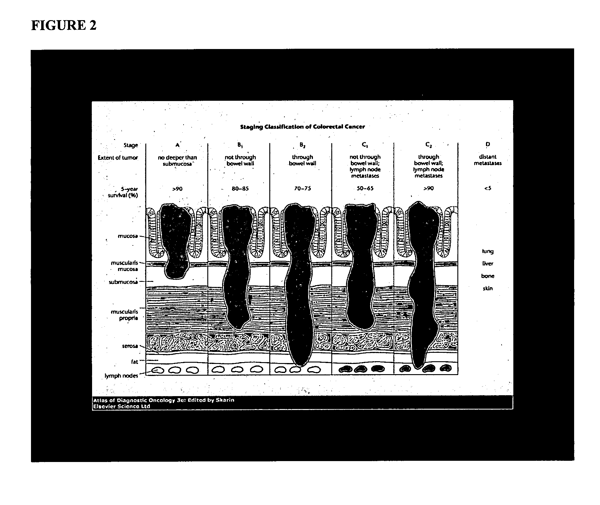 Reagents and methods for cancer prognosis and pathological staging