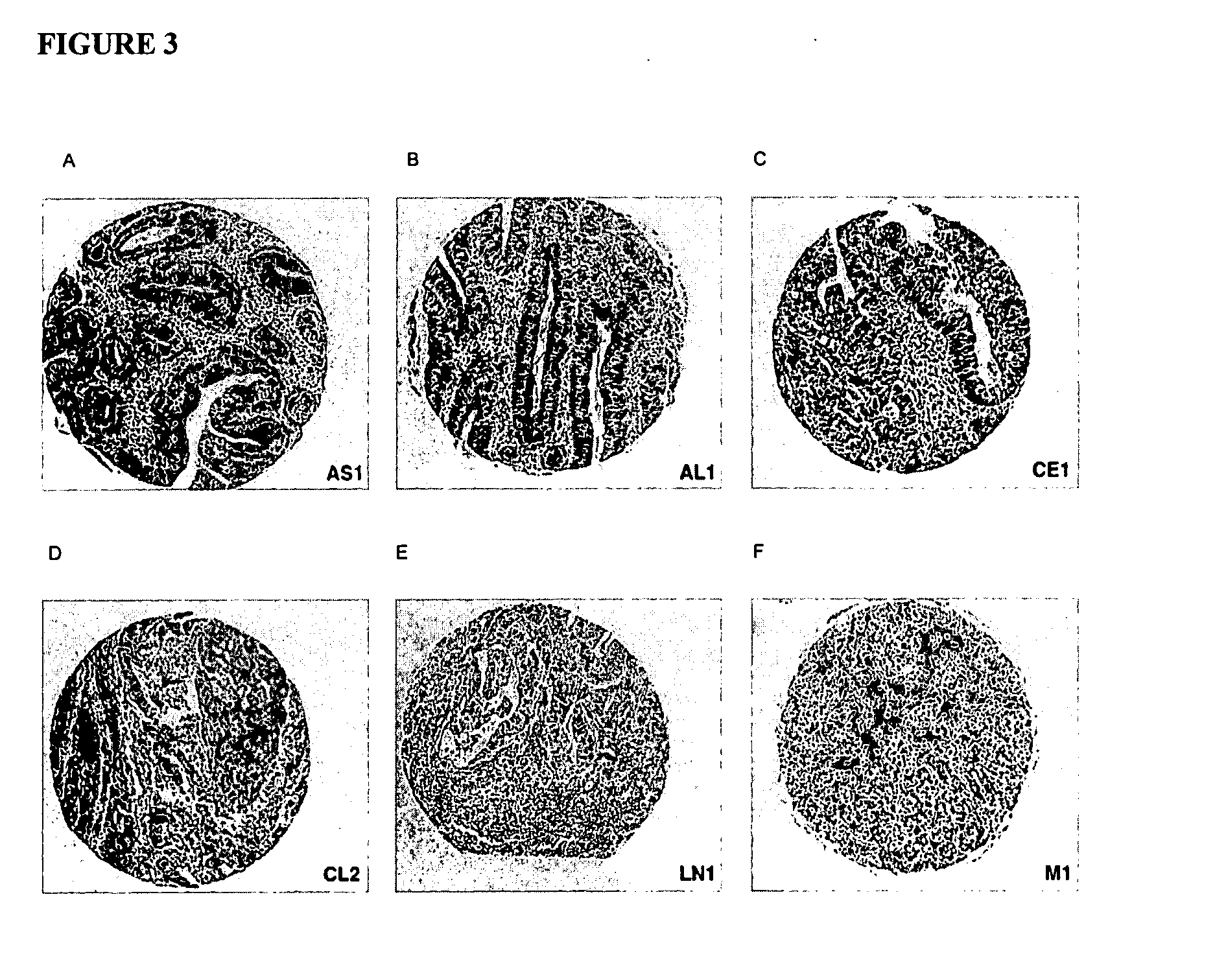 Reagents and methods for cancer prognosis and pathological staging