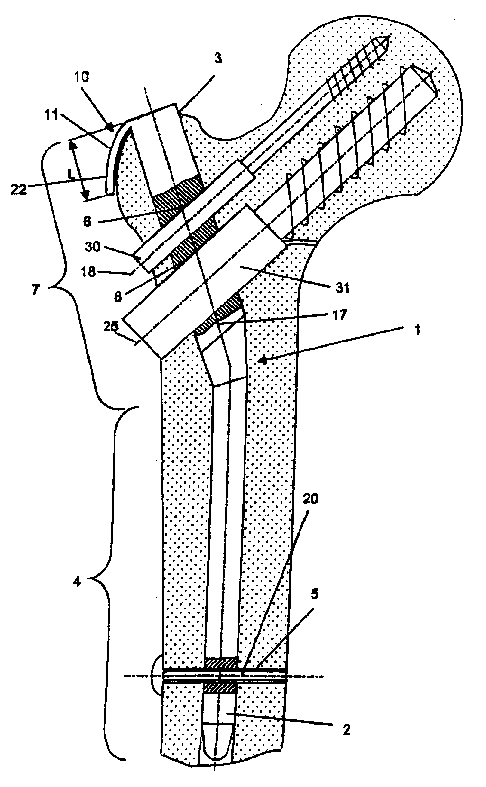 Device for Bone Fixation