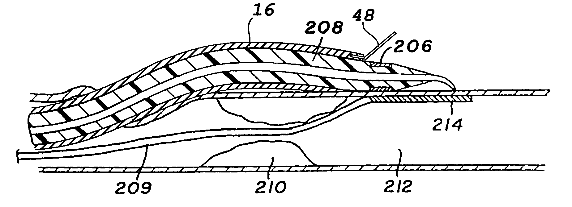 Percutaneous bypass graft and securing system