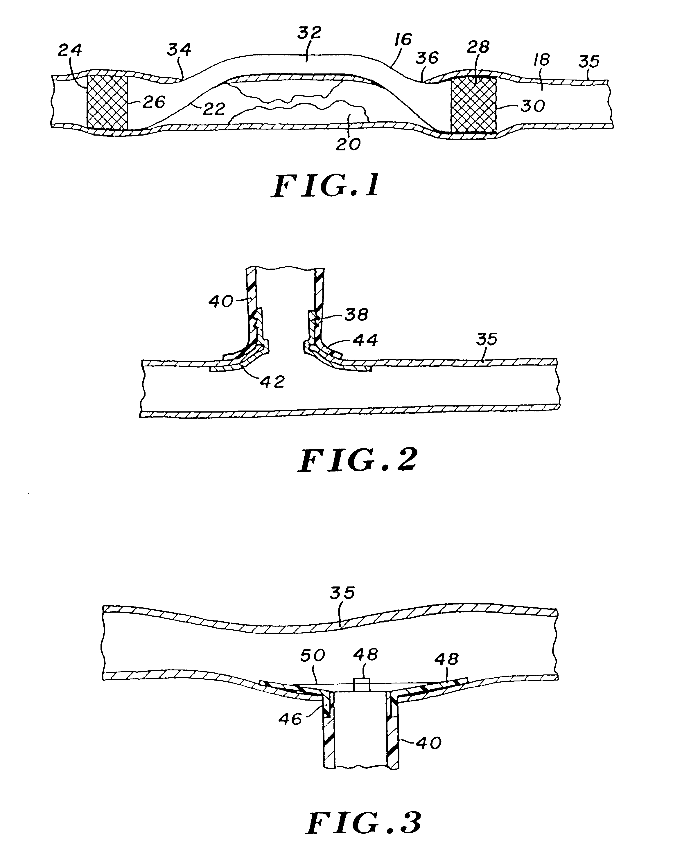 Percutaneous bypass graft and securing system