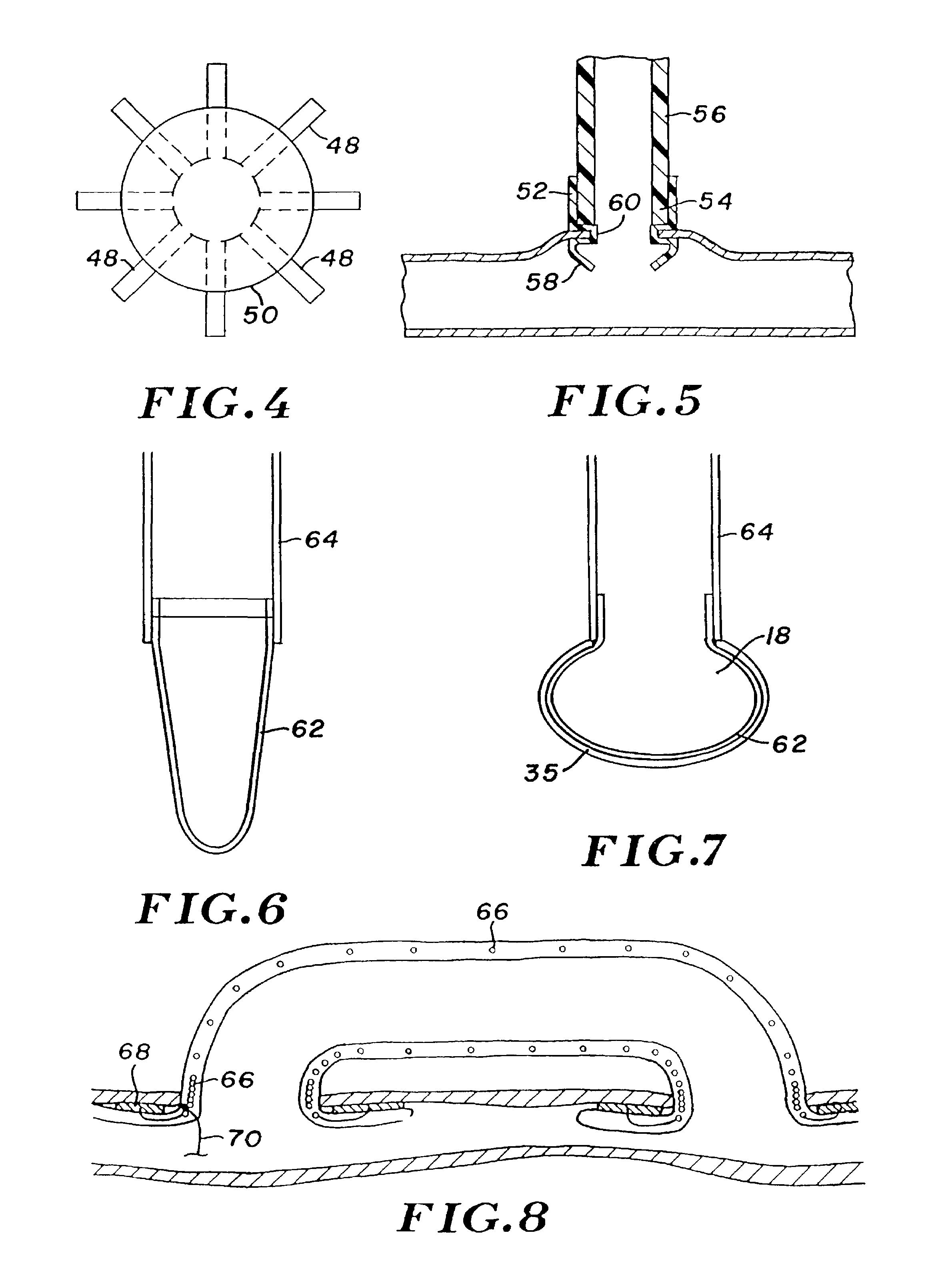 Percutaneous bypass graft and securing system