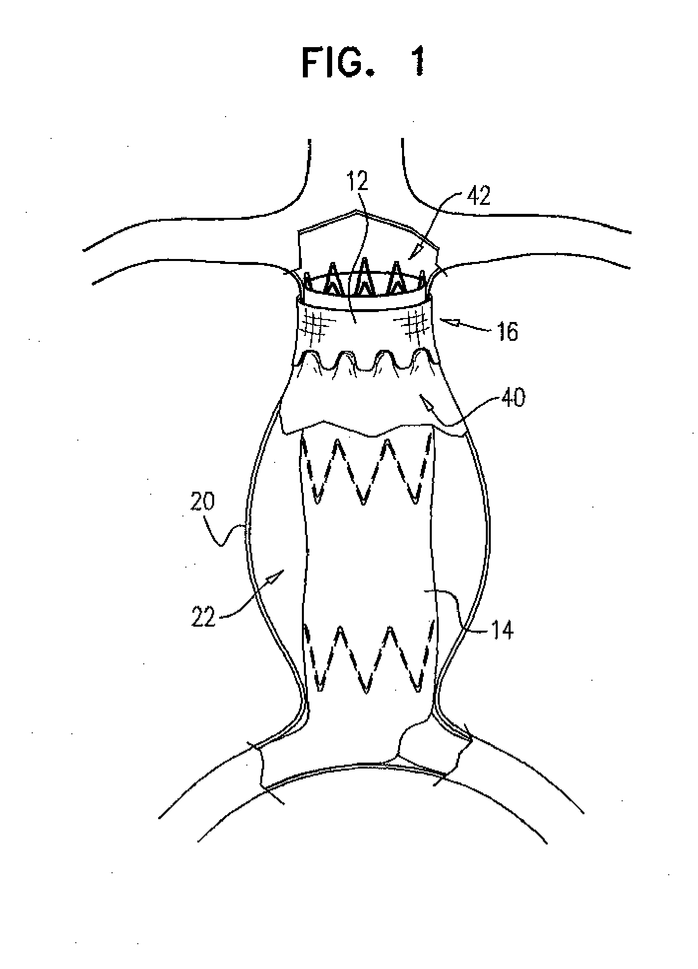 Reduced-strain extra- vascular ring for treating aortic aneurysm