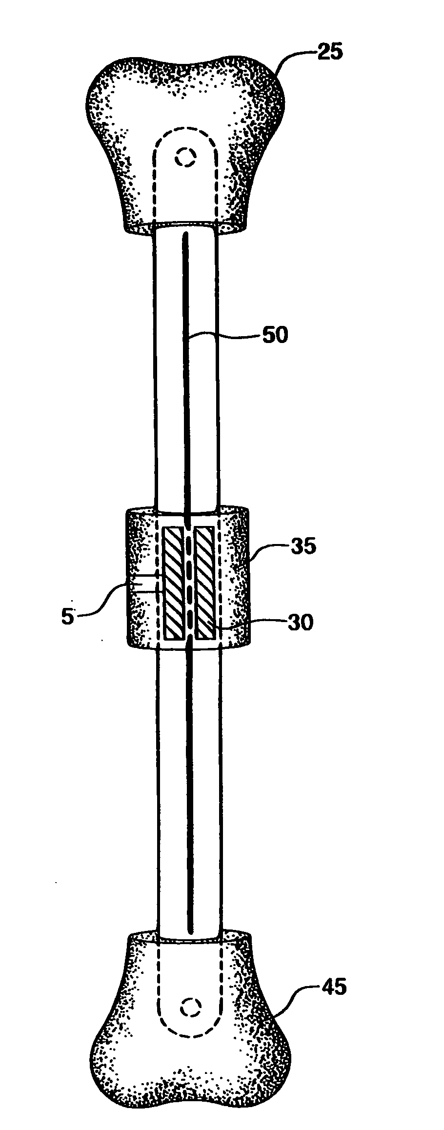 Internal bone transport