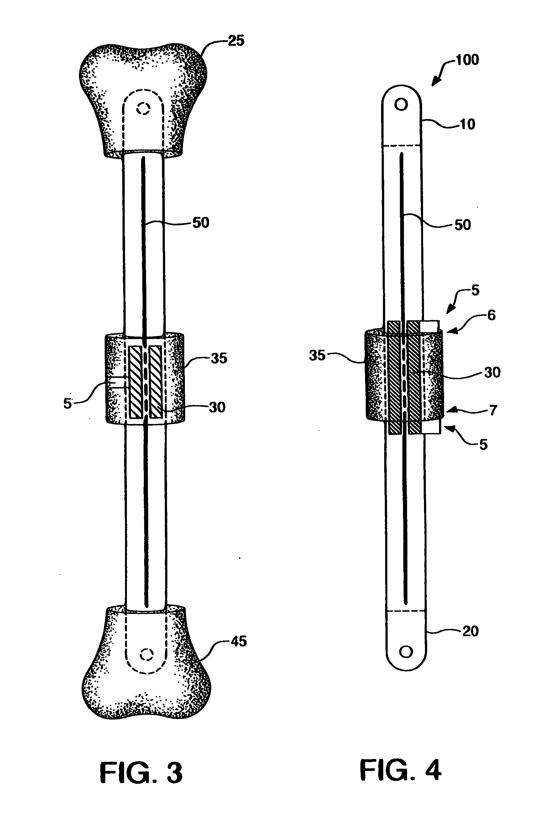 Internal bone transport